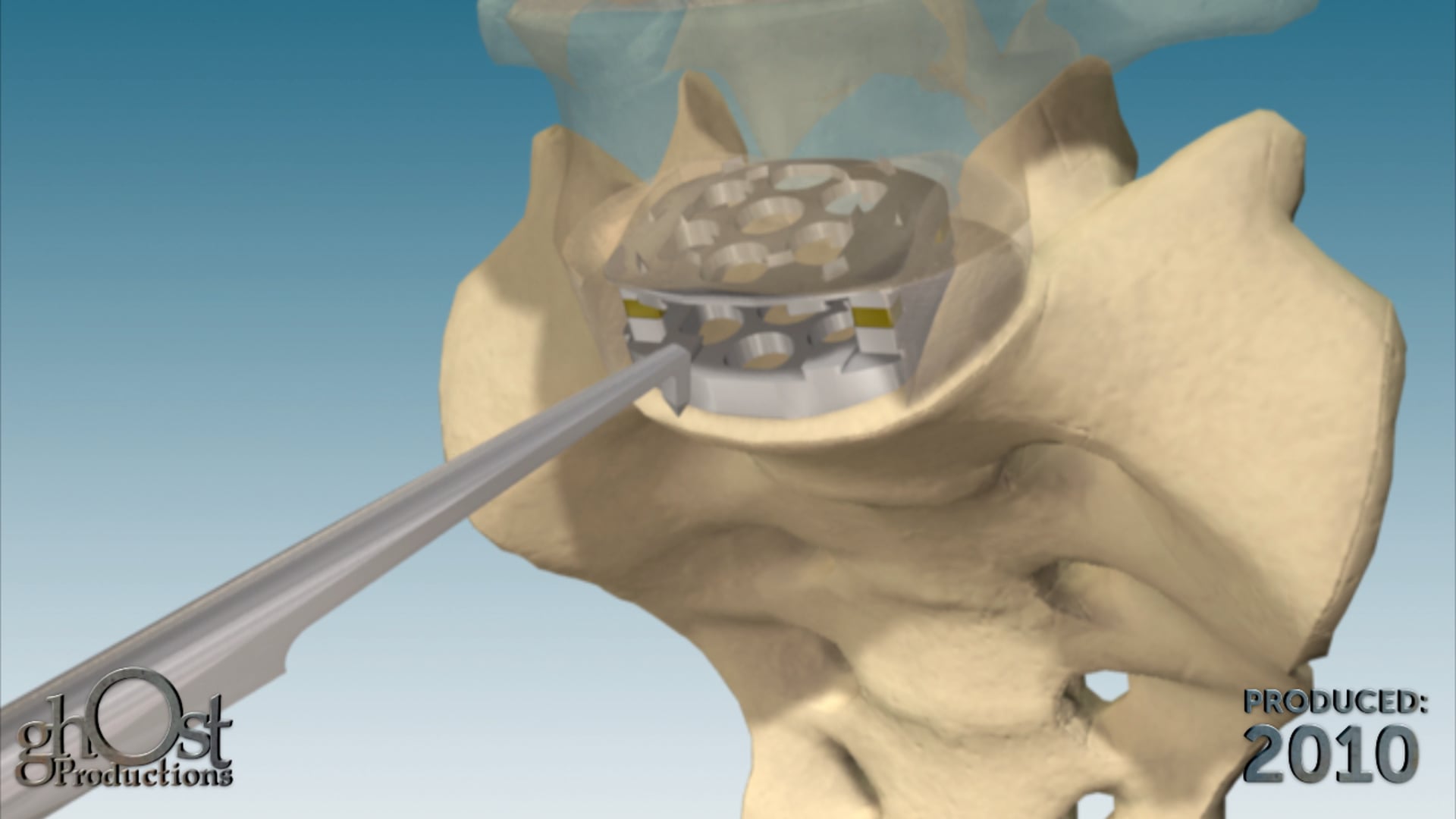 Zimmer Spine, Ghost Productions, technique animation, InFix device, anterior lumbar spinal implant, bone growth, titanium, spinal injuries, degenerative conditions, assembly, insertion, medical professionals, patients, benefits, innovation, excellence, spinal medicine.