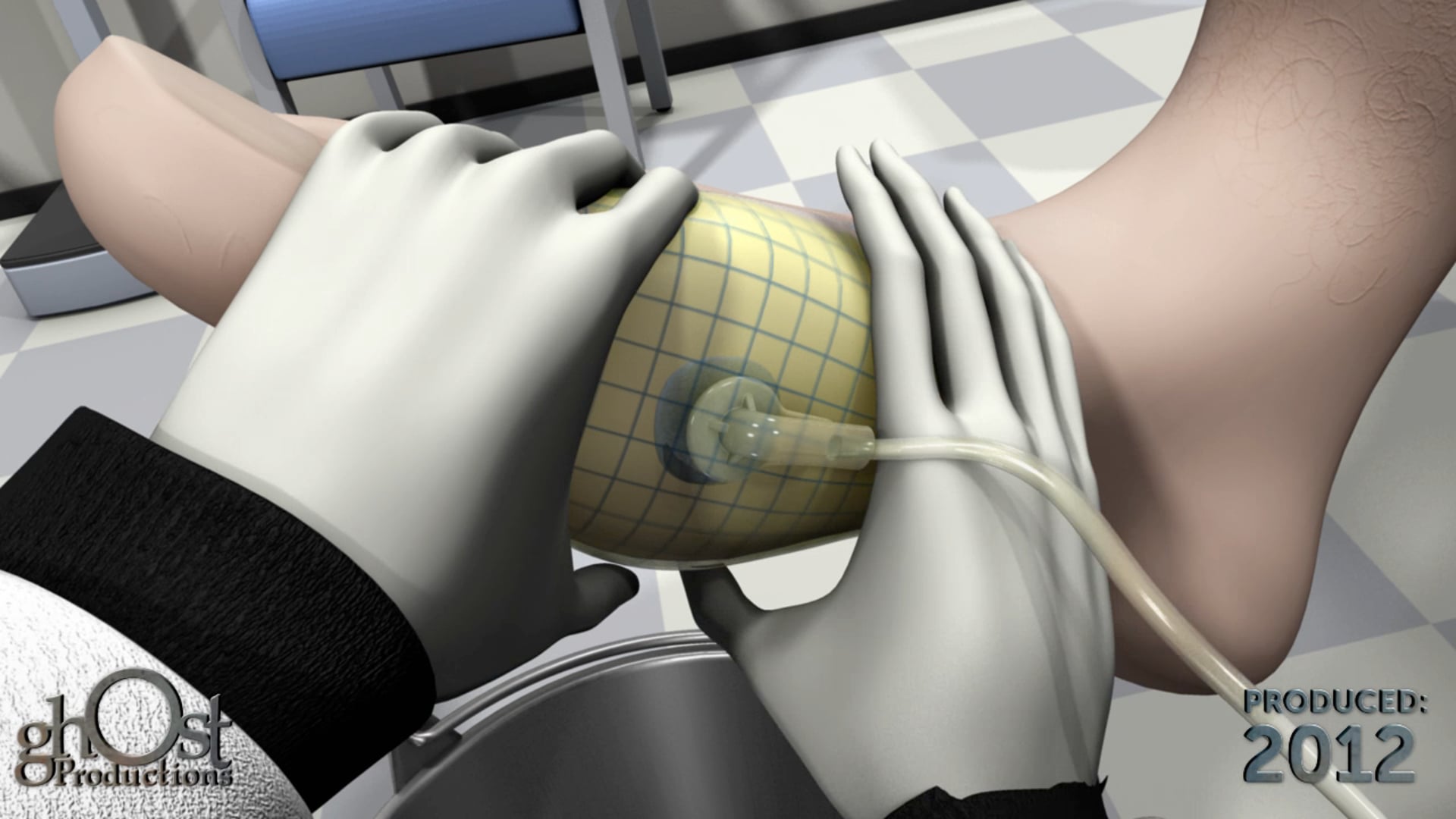 Revolutionizing Wound Care with Ghost Medical's Spiracur Snap