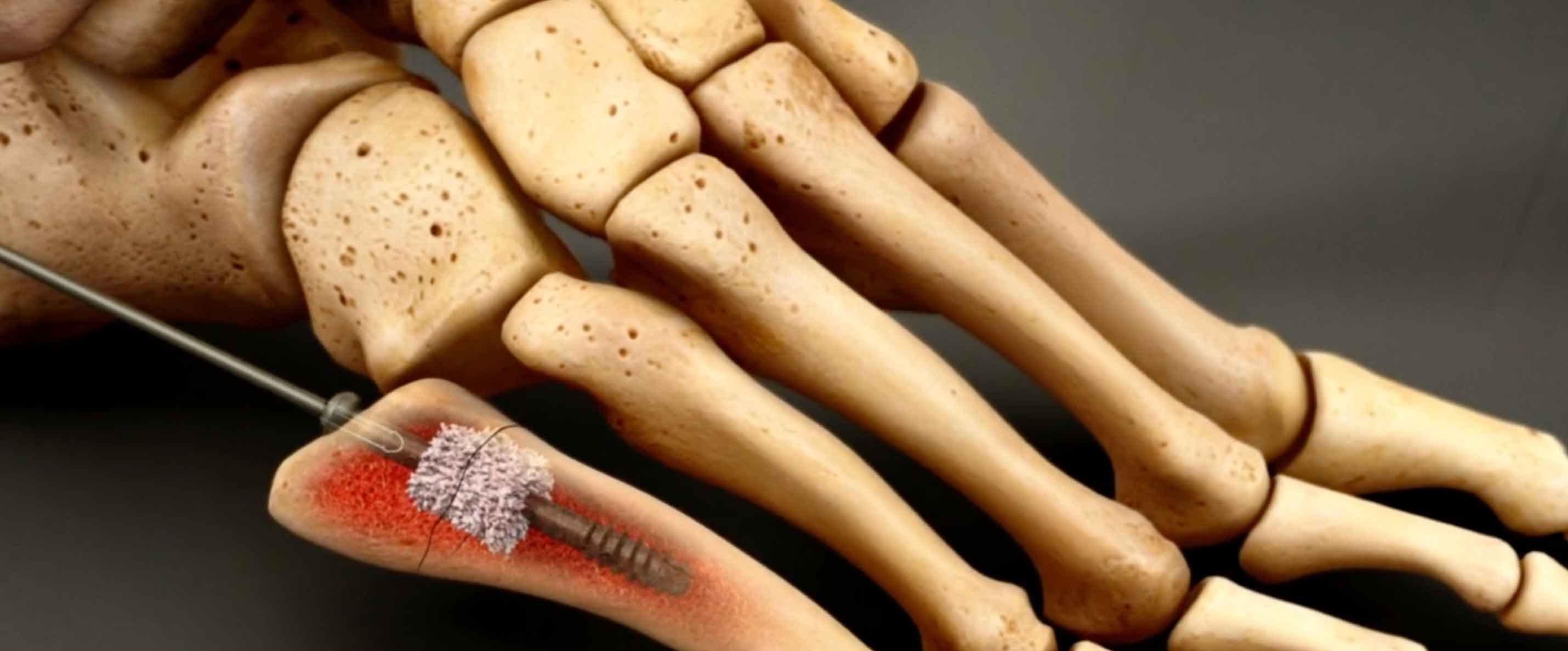 Cannulated Screw Animation Case Study: FlowFX