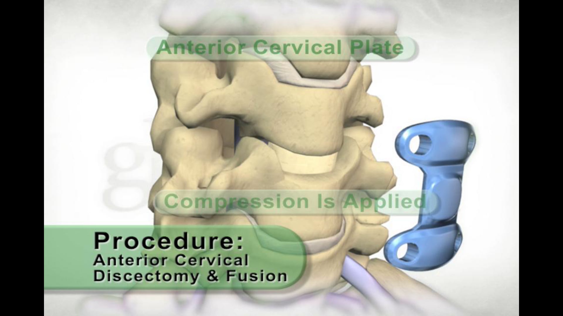 prolapsed cervical disc, nerve irritation, shoulder pain, arm pain, surgical removal, nerve decompression, spacer insertion, vertebrae compression, anterior cervical plate, vertebrae stabilization, fusion stimulation, orthopedic surgery, cervical disc disorders, medical animation, medical visualization, medical education, medical promotion, Ghost Productions.