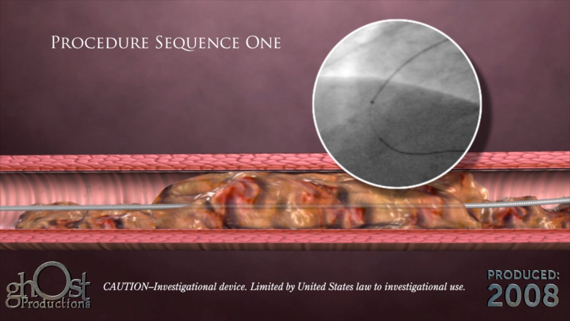 Ghost Medical presents: The BridgePoint CrossBoss Animation