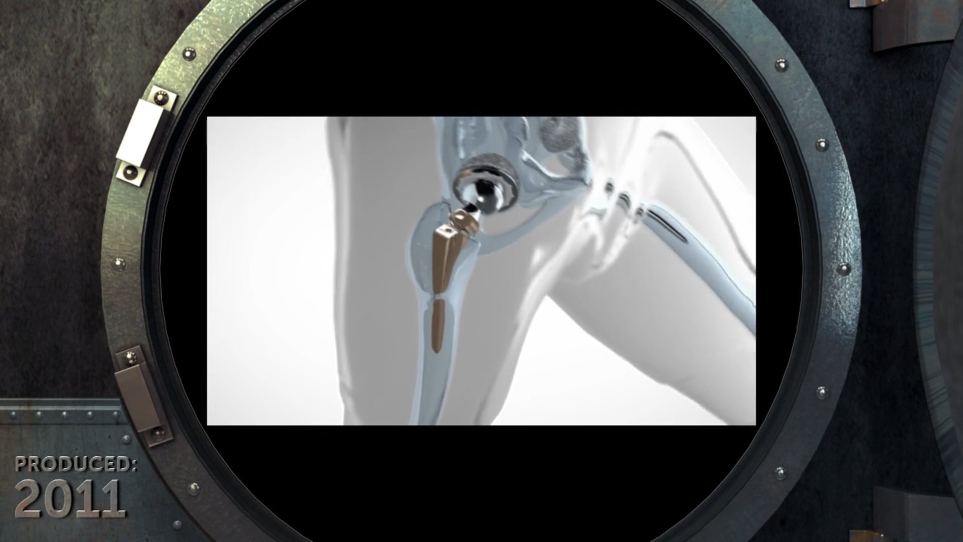 Zimmer hip device, hip replacement surgery, orthopedic medicine, joint function, mobility, medical product, animation, medical accuracy, Zimmer glass man, joint placement, effectiveness, search engine optimization, medical information.