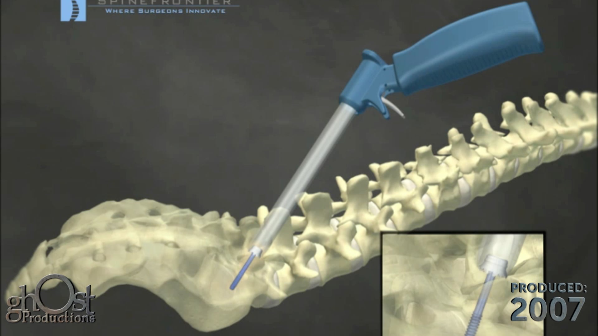 Ghost Medical Presents: Spine Frontier Lumbar