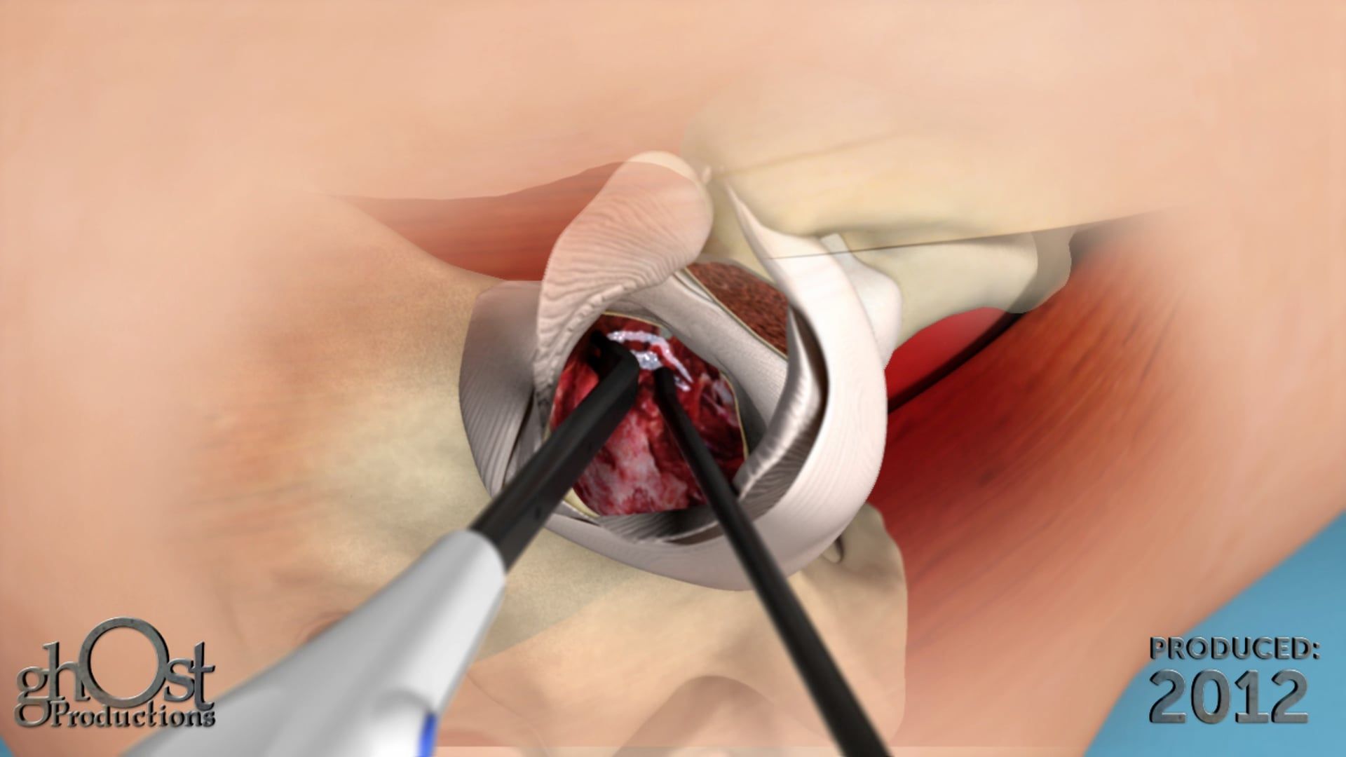 Discover the power of Medtronic's Aquamantys electrosurgical device for better surgical outcomes with less blood loss and reduced operating room time.