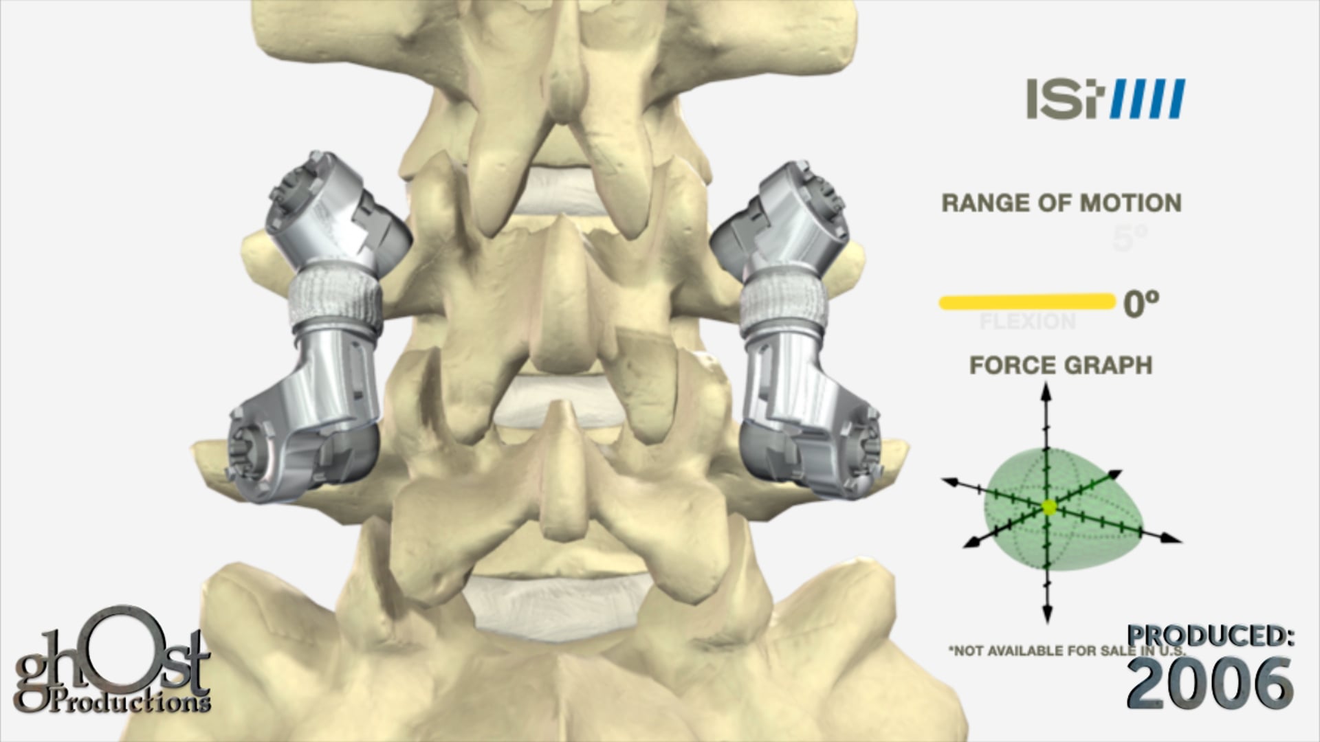 Innovative Spinal Technology MicroMotion by Ghost Medical