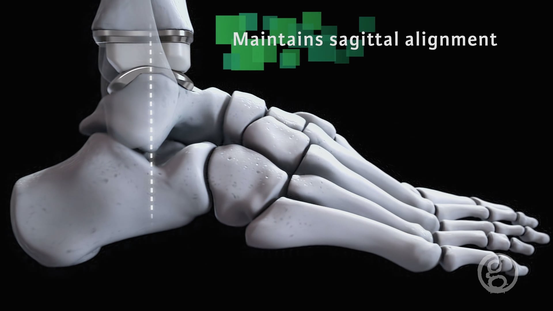 Ghost Medical - Integra LifeSciences Cadence Total Ankle Animation