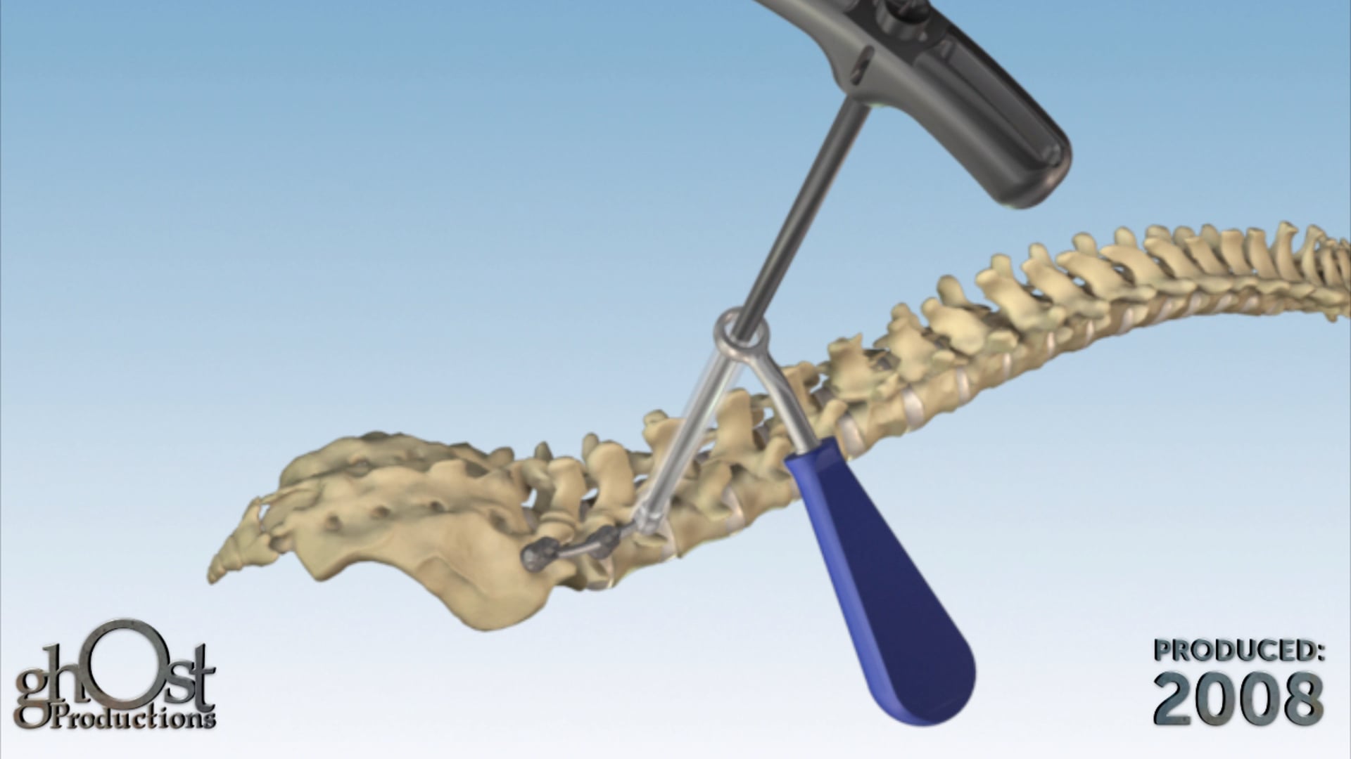 Zimmer Spine, Ghost Productions, surgical technique animation, InCompass system, pedicle fixation system, spine surgery, lumbar vertebrae, medical professionals, product benefits, advancing spinal surgery, search engine optimization, healthcare professionals.
