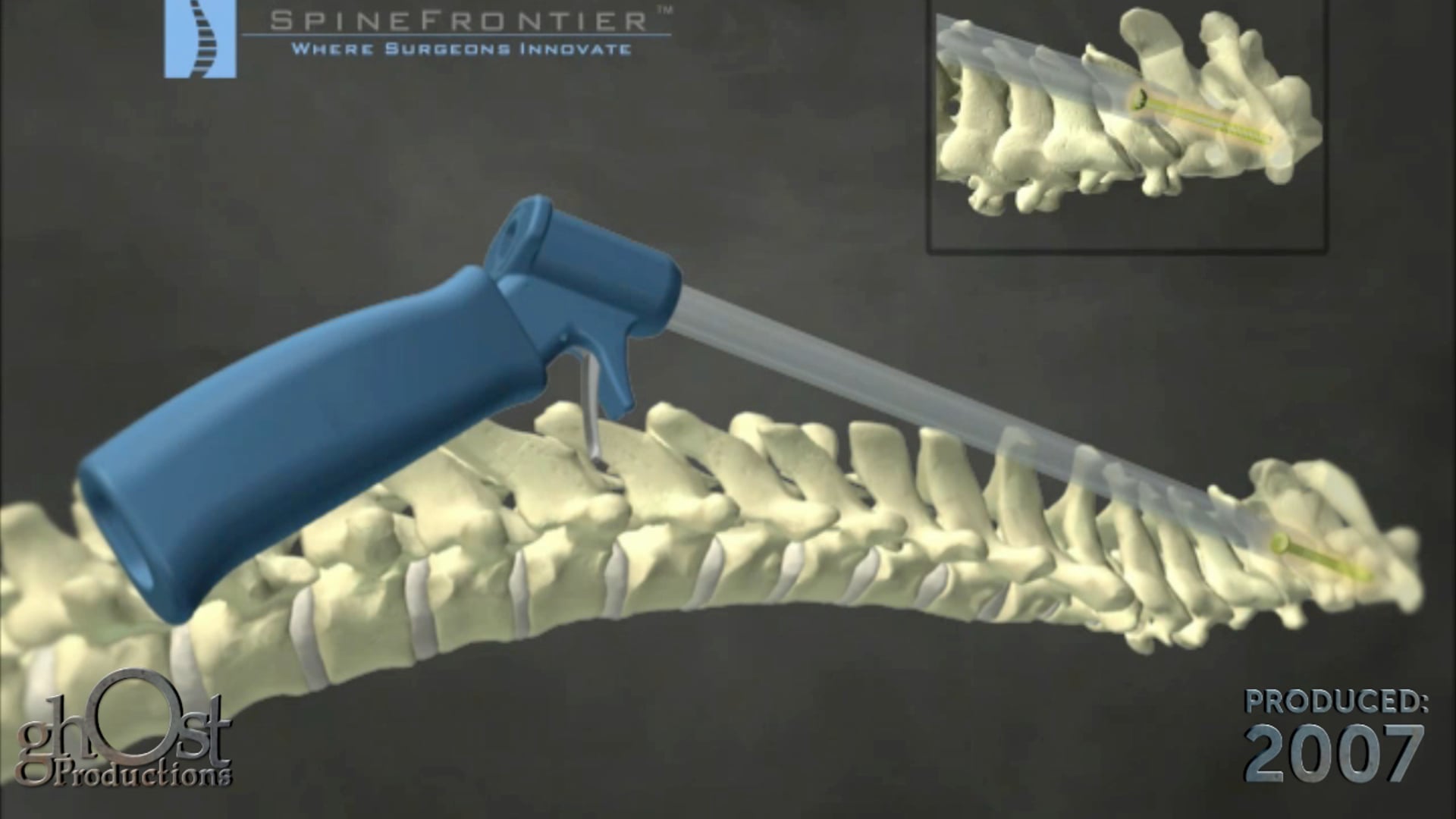 Ghost Medical Presents: Spine Frontier Cervical Animation