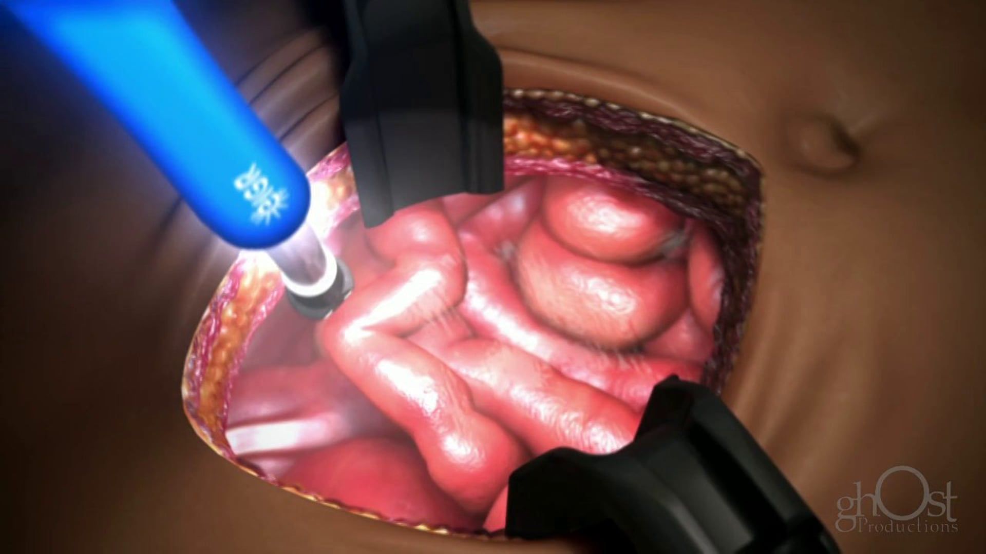 Ghost Medical - Invuity - Yankauer Marketing Reel