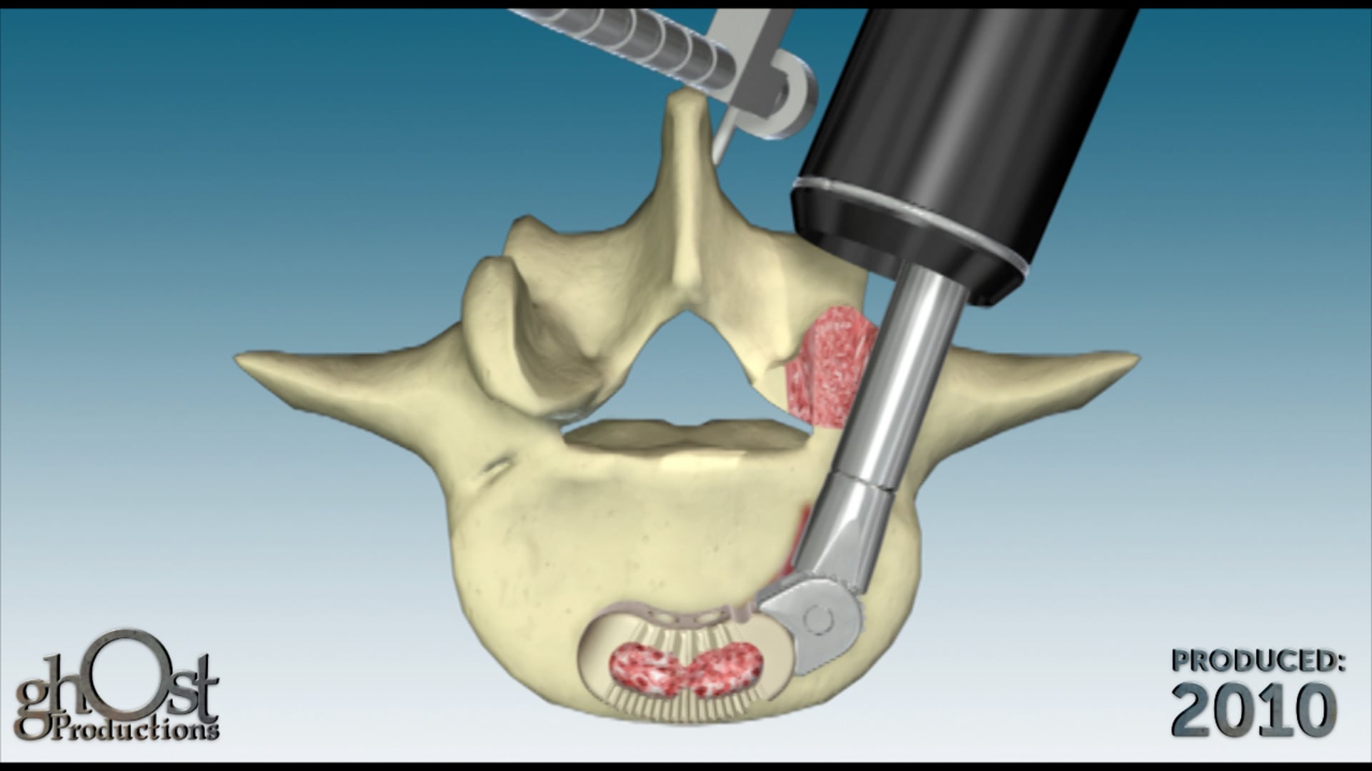 Zimmer Spine, Ghost Productions, Traxis device, spinal implant, minimally invasive surgical, transforaminal lumbar interbody fusion, TLIF procedures, bone graft material, consistent results, reliable results, unique features, benefits, spinal surgery, innovative product, medical professionals, patients.