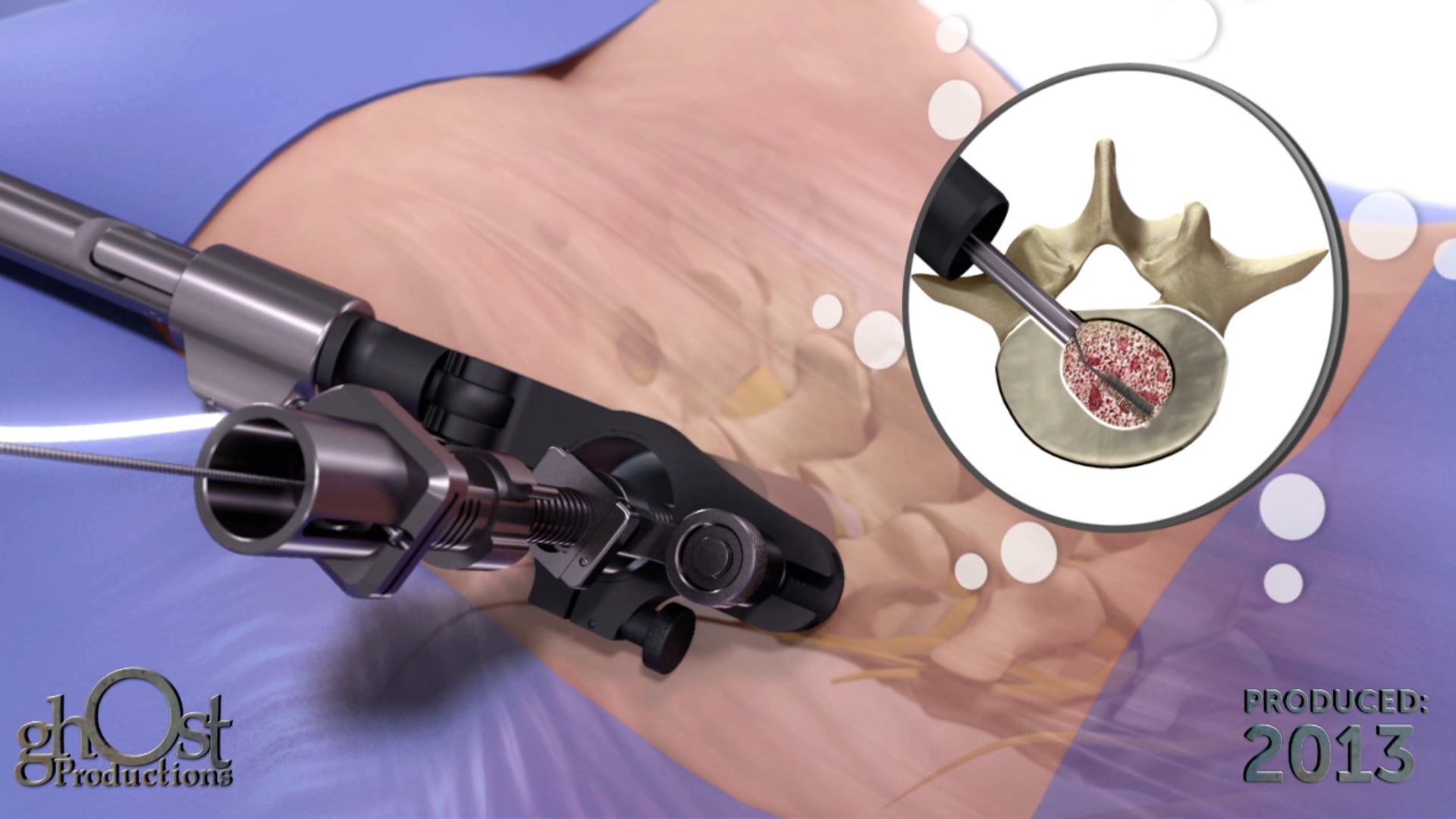 Spineology, SOAR system, interbody fusion procedures, neurologic risk, OADS device, facet-preserving access, spinal surgery, game-changer, safer, more effective, medical animation, Ghost Productions.