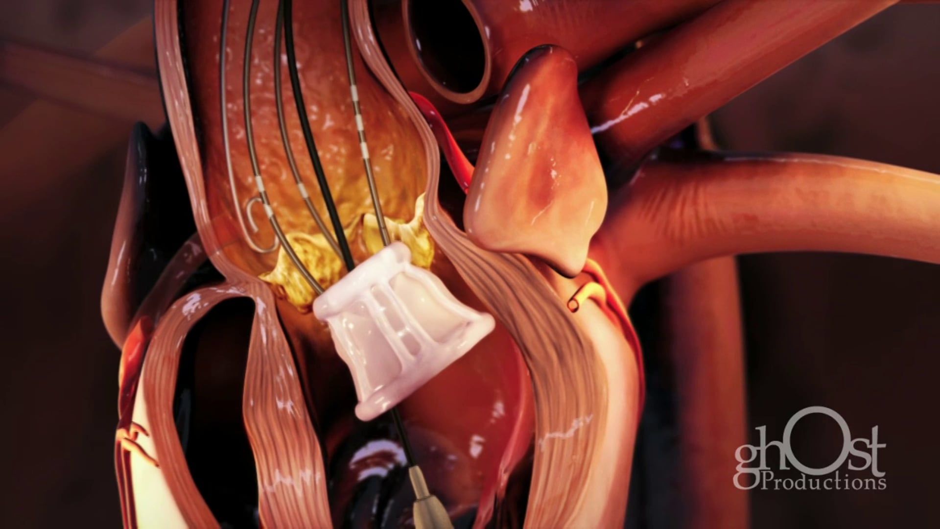 Direct Flow, medical device company, Ghost Productions, informative animation, Direct Flow Valve, aortic stenosis, heart condition, blood flow, medically accurate depiction, method-of-action, unique design, advanced technology, healthcare professionals, patients, life-saving product, cardiovascular medicine, latest advancements.