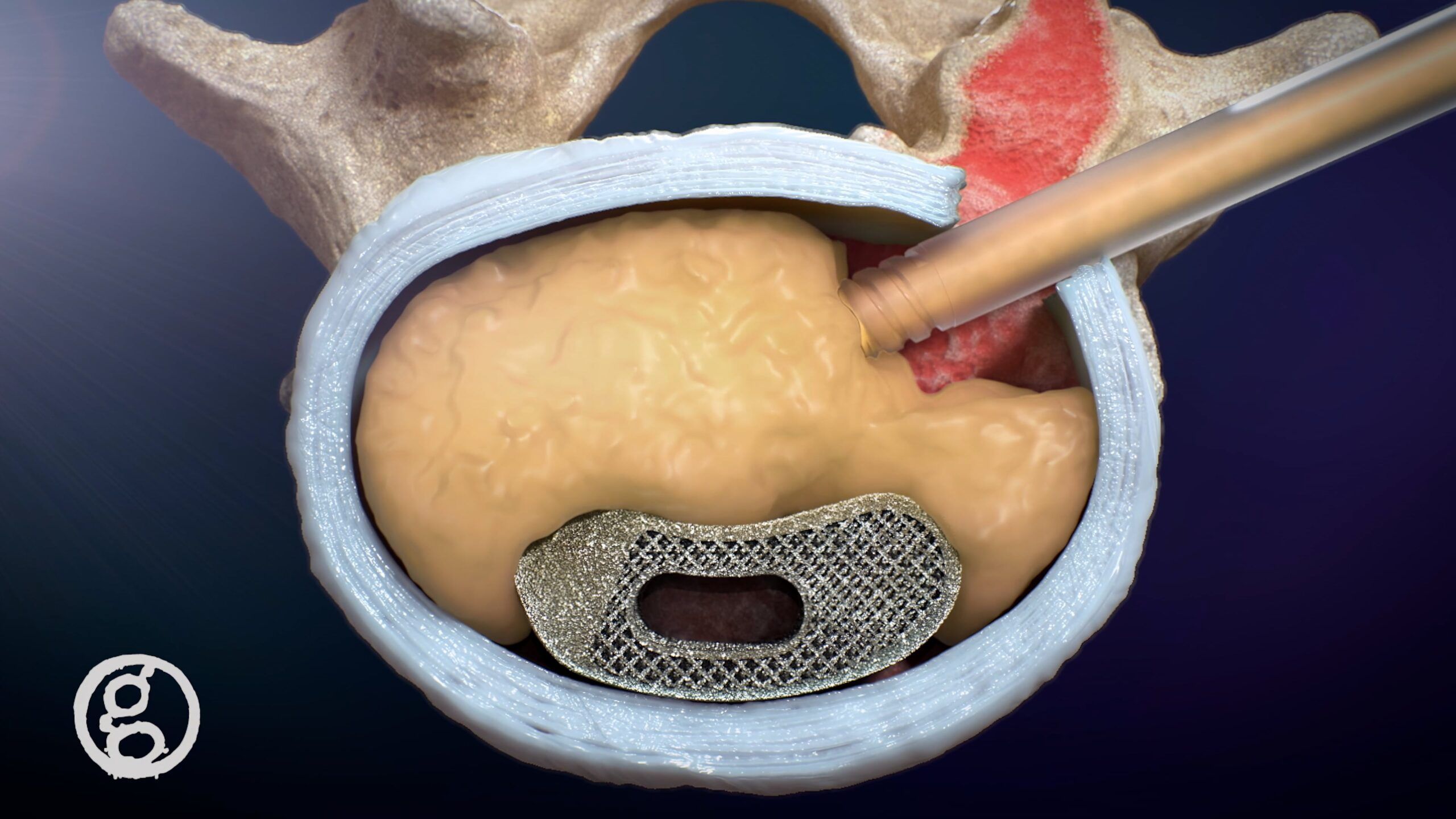 Ghost Medical Device Marketing Demo Reel