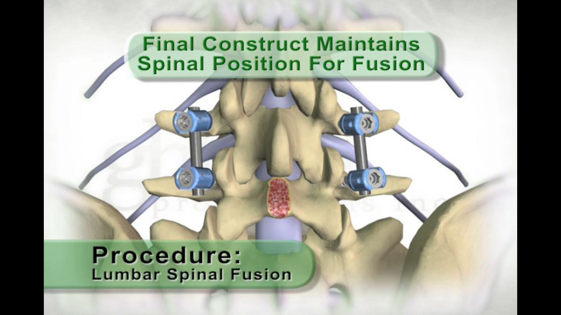 medical animation, boney decompression, nerve root foramen, pedicle fixation systems, spinal fusion, removal of boney obstructions, nerve irritation, symmetrically aligned retention screws, support rods, proper spinal position, fusion, orthopedic medicine, educational video, freely distributed, .edu websites, .org websites, active link, www.ghostproductions.com.