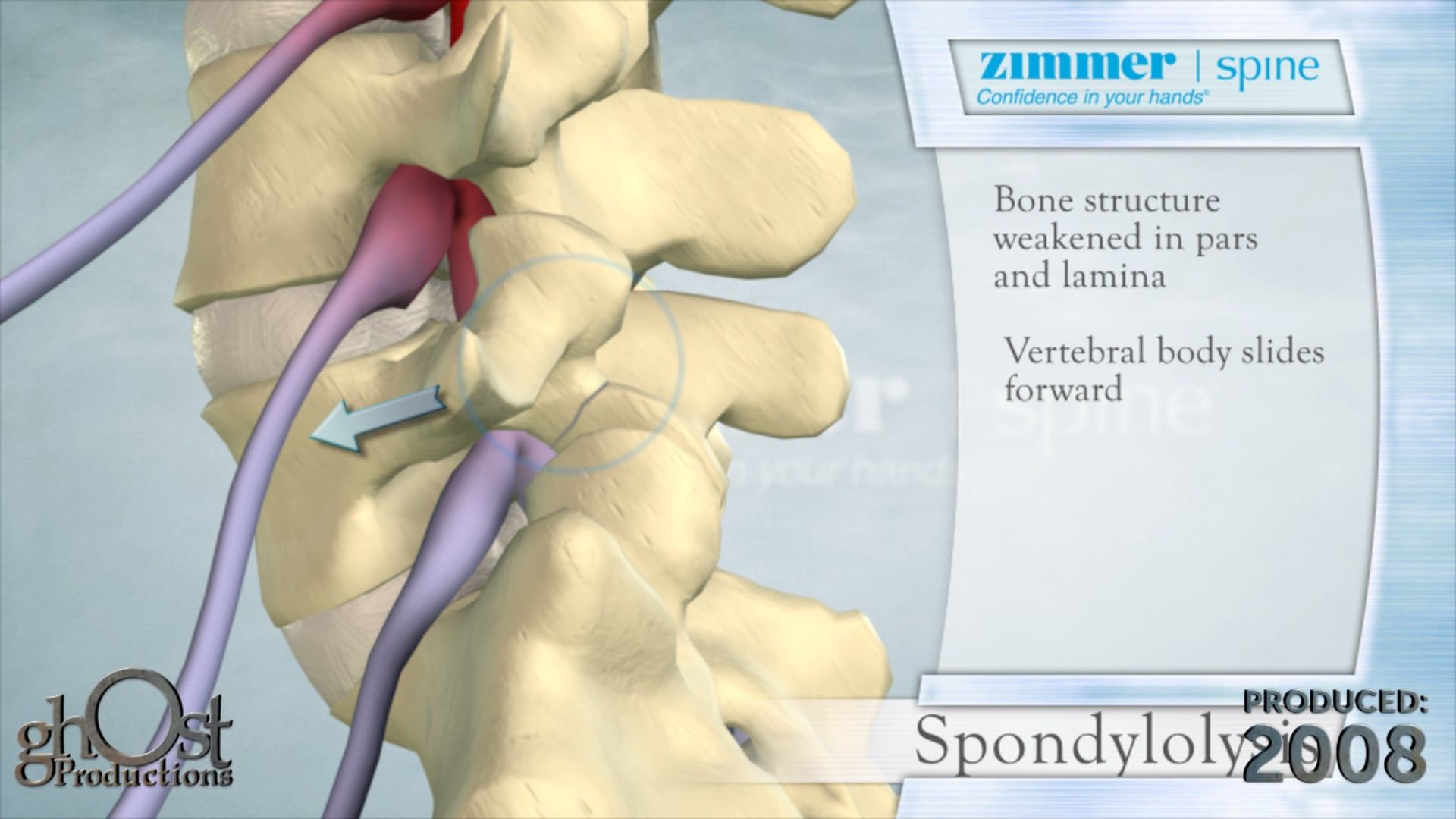 Zimmer, Ghost Productions, Spondylolysis, medical device company, animation, causes, effects, vertebrae, lower back, pain, weakness, paralysis, detailed, medically accurate, description, symptoms, treatment options, healthcare professionals, patients, invaluable resource, search engine results.
