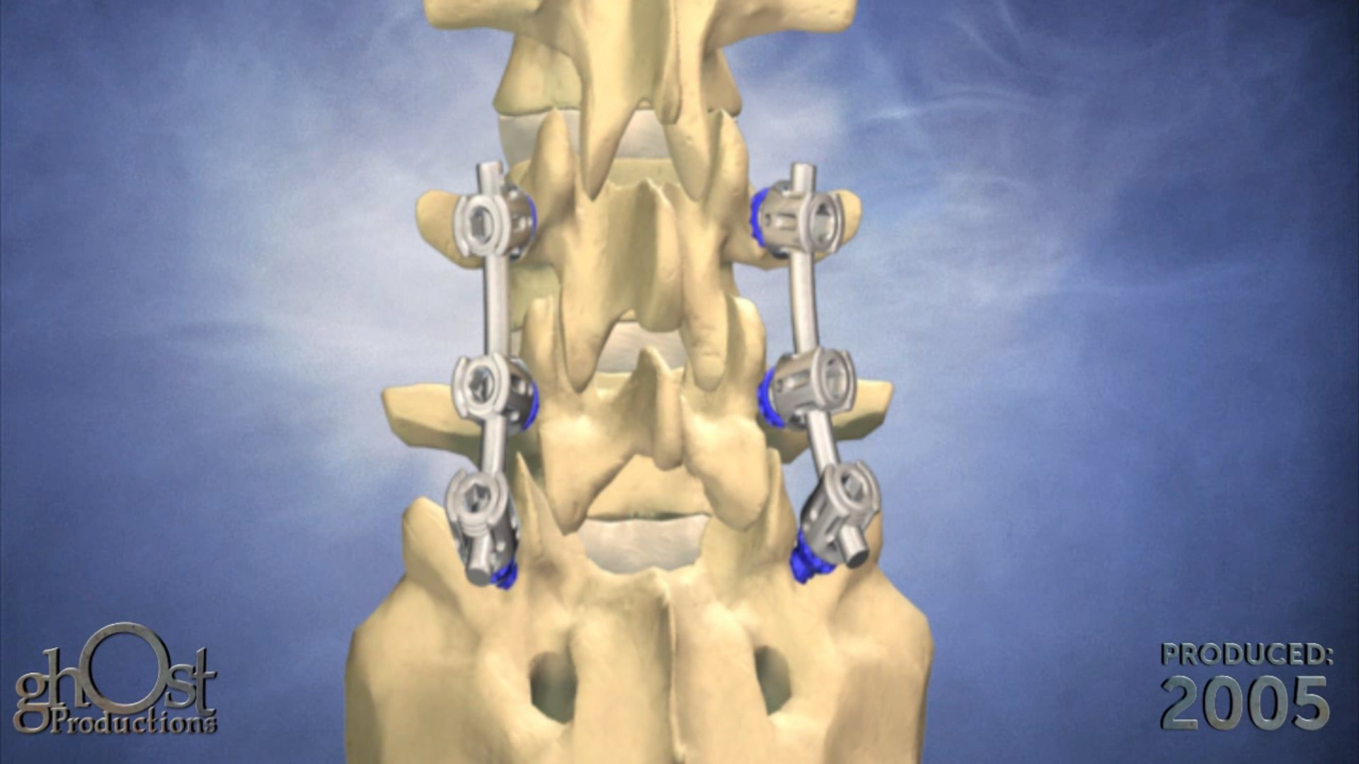 Ghost Medical Presents: Issys Surgical Technique