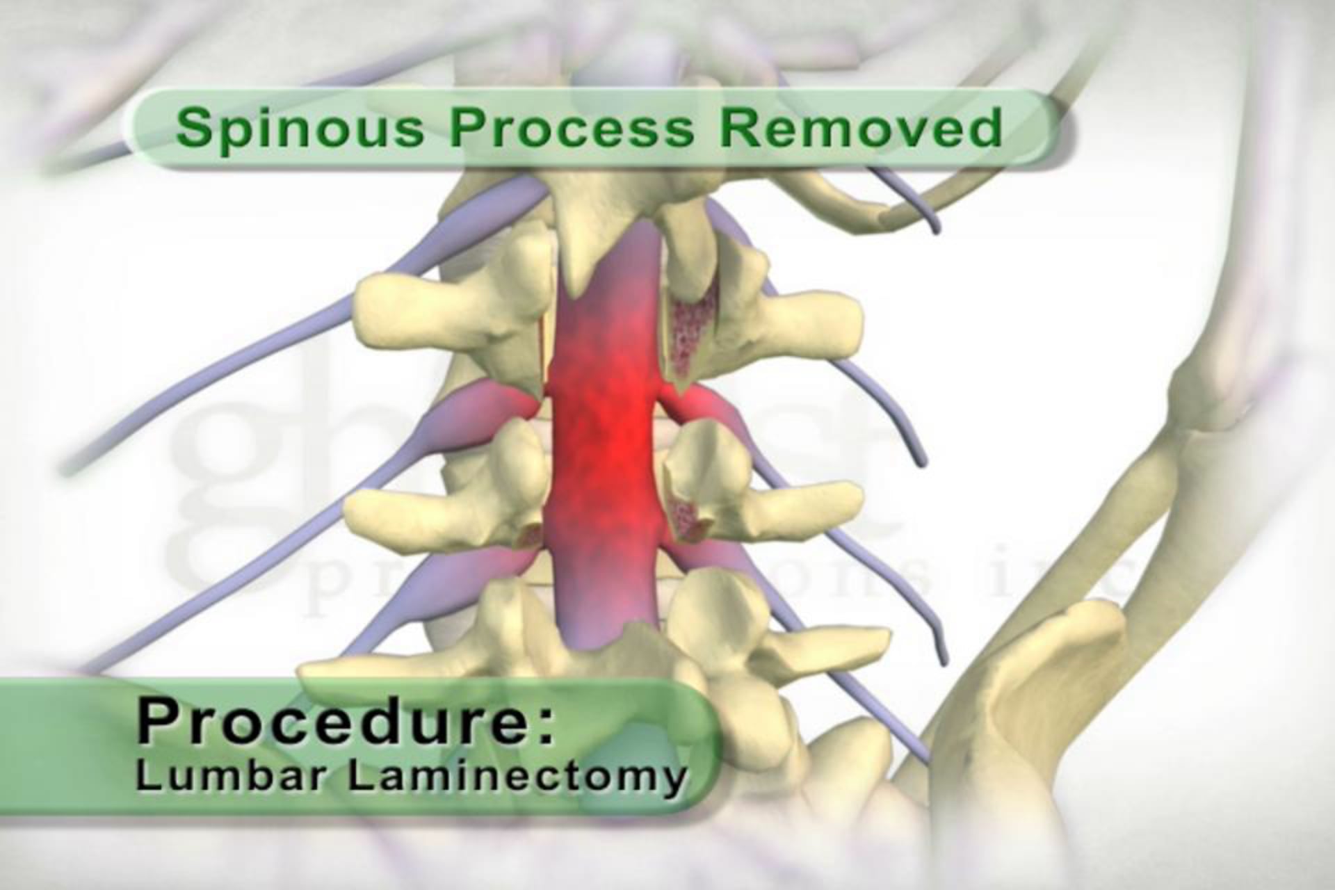 medical animation, spinal anatomy, neurosurgery, educational resource, Ghost Productions, spinal cord, nerve roots, vertebral anatomy, spinous process, lamina, medical professionals, medical students, client's product, medical accuracy, freely distributed, .edu websites, .org websites, active link.