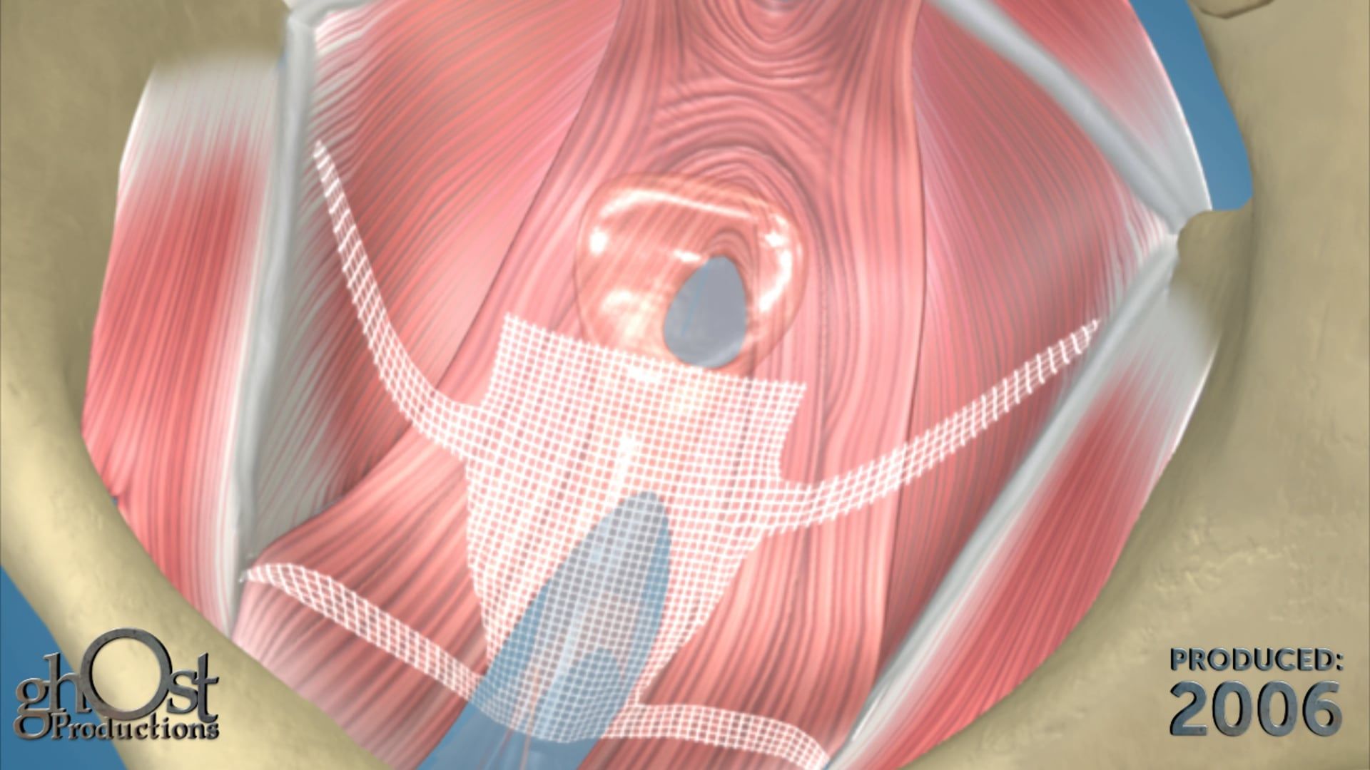 Ghost Productions offers a comprehensive animation of the AMS Perigee vaginal mesh implantation for vaginal prolapse treatment. Trust us for medical animation needs.