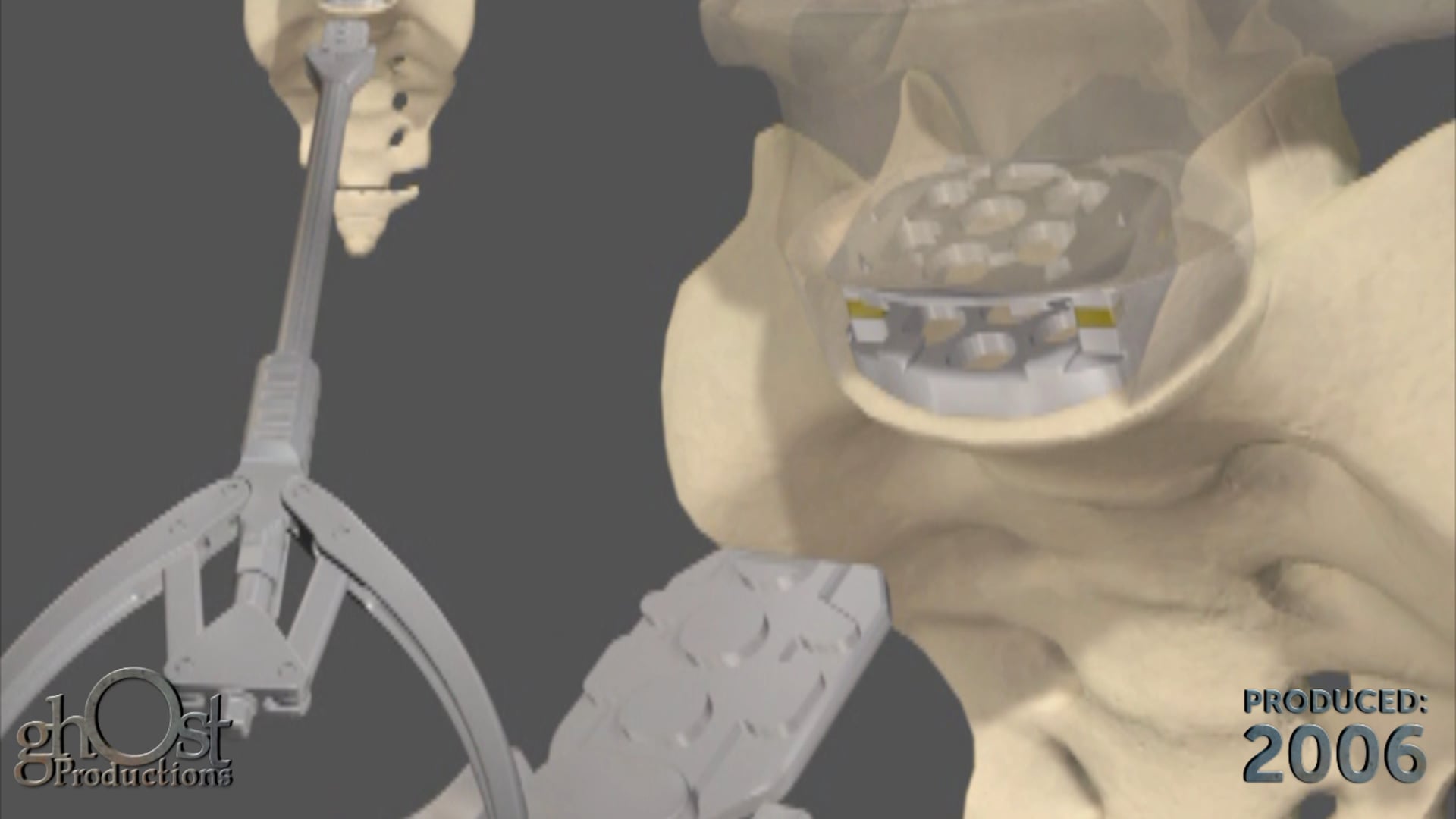 Abbott InFixMain: Revolutionizing Medical Procedures with Ghost Medical Technology