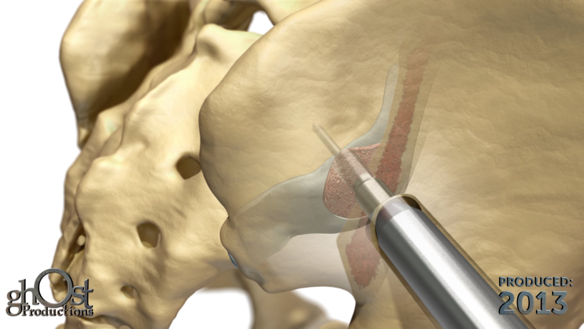 Ghost Medical Presents: Zyga SImmetry - A Revolutionary Solution for Chronic Low Back Pain