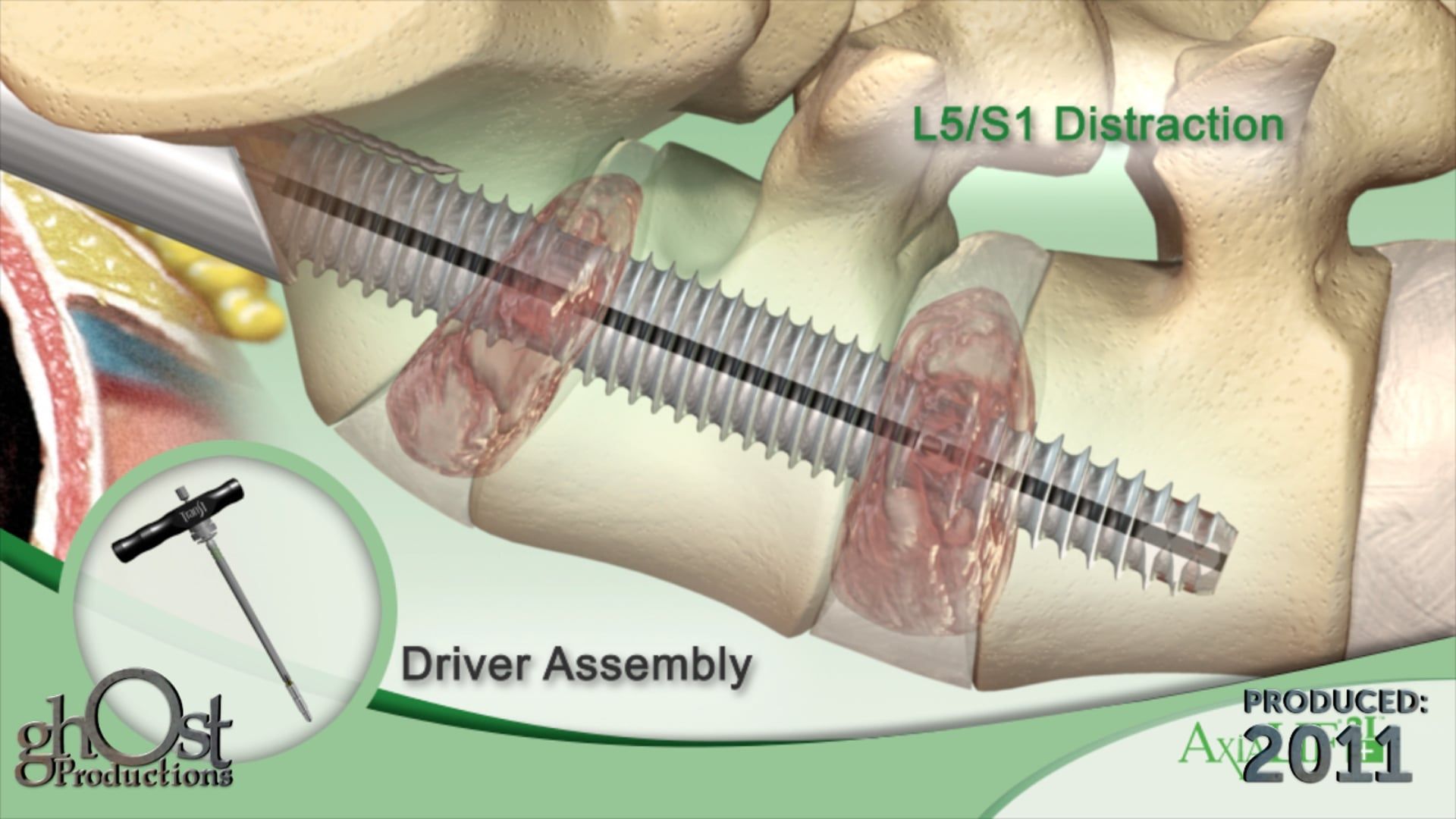 Revolutionizing Spinal Surgery with Ghost Medical's TranS1 AxiaLIF2L