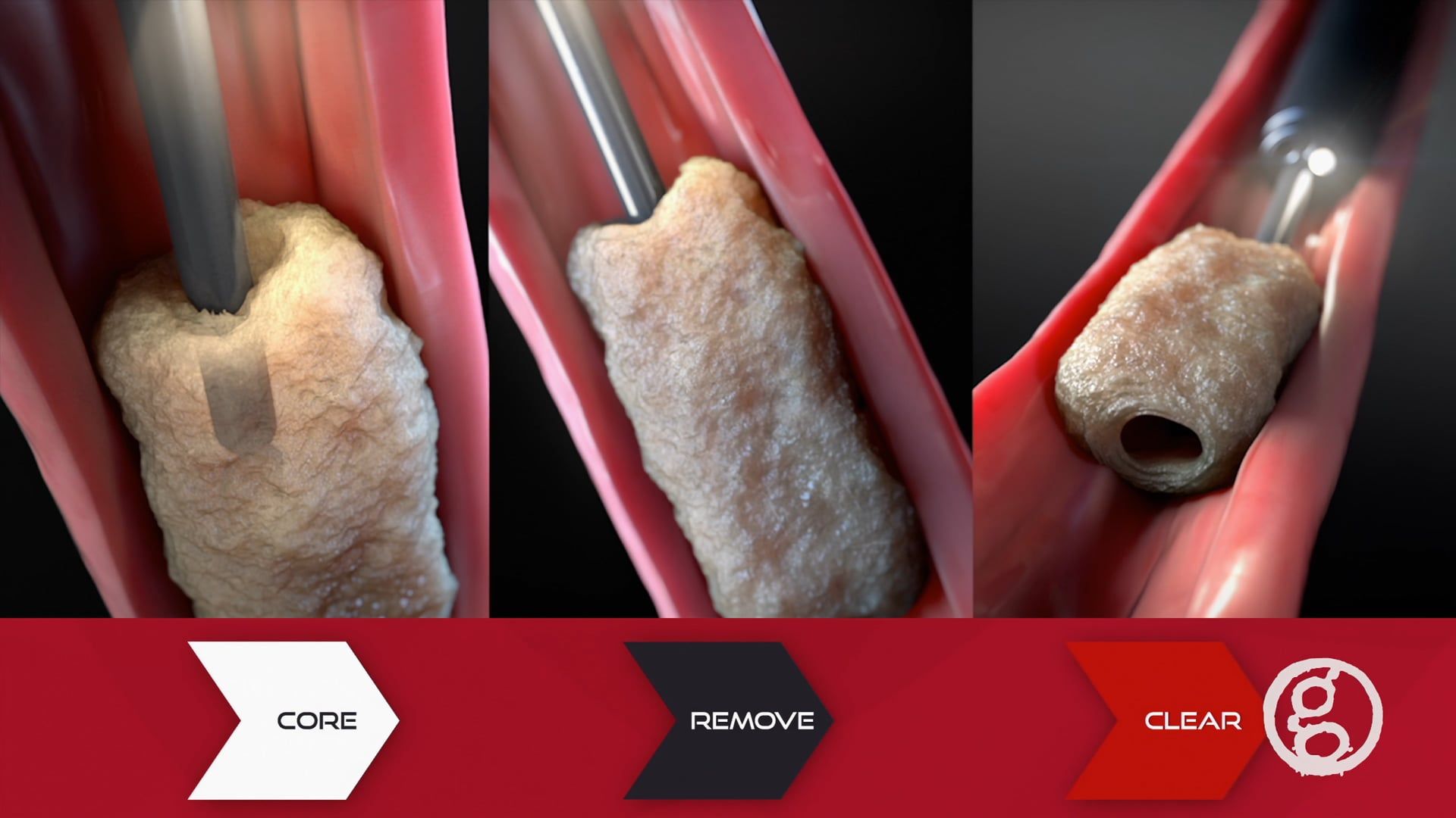 CLEANS Technique for Esophageal Food Impaction with Biomerics Piranha ER Sheath and Aspiration Catheter - Ghost Medical Solutions