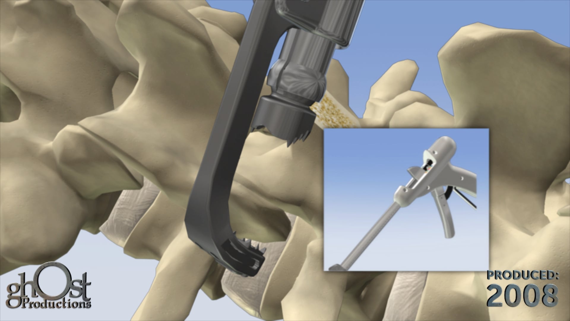 Ghost Medical's US Spine Facet Gun Teaser