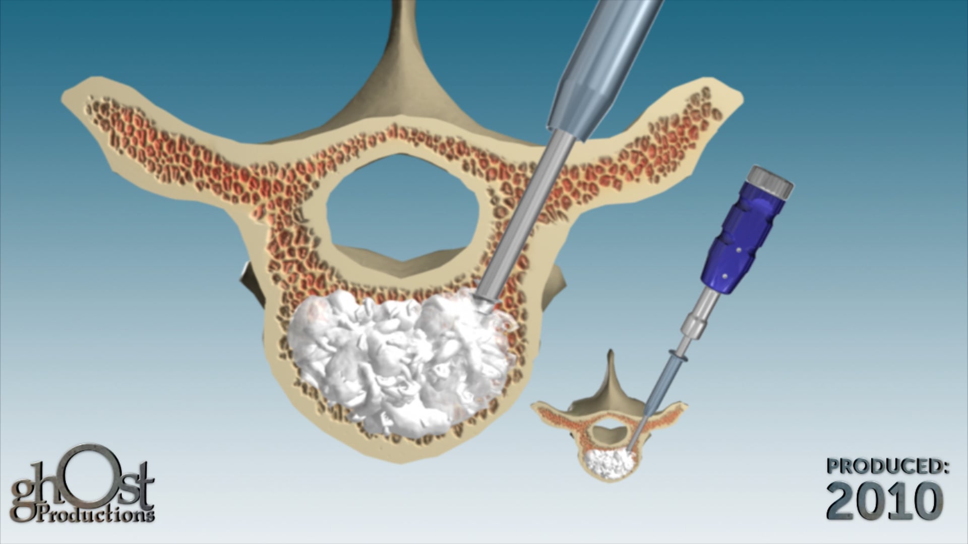 Zimmer Spine, Ghost Productions, Pedestal technology, infusion tooling, bone cement, spinal fractures, minimally invasive solution, medical professionals, patients, spinal medicine.
