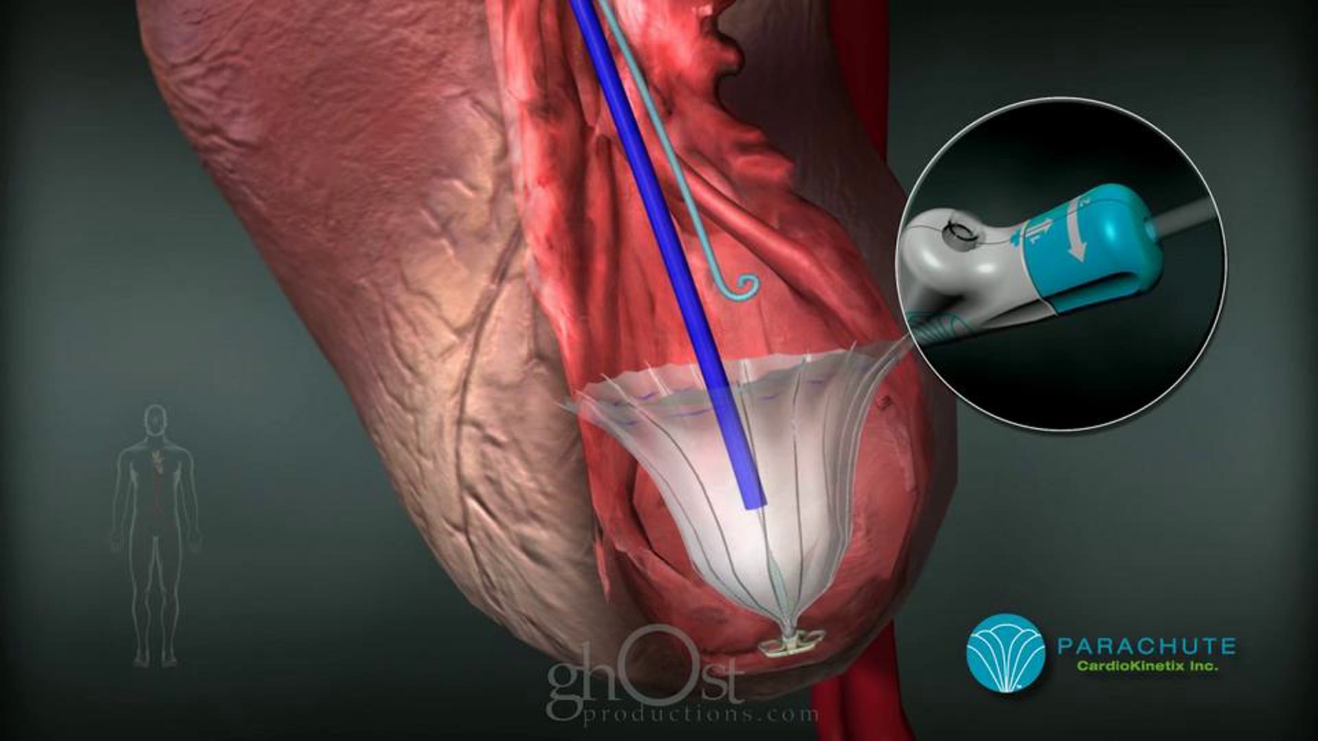 cardiology, procedural animation, Ghost Productions, CardioKinetix, Parachute VPD, ventricle, medical advancements, future of medicine, informative, visually stunning, clear explanations, latest developments