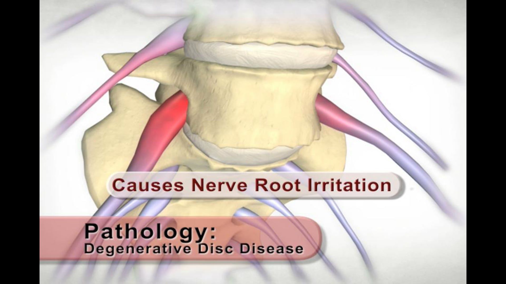medical animation, spinal health, disc height, bone spurs, nerve roots, sciatica, Ghost Productions, educational video, .edu websites, .org websites, back pain, leg pain, lateral motion, endplates, age, injury, active link, distribution