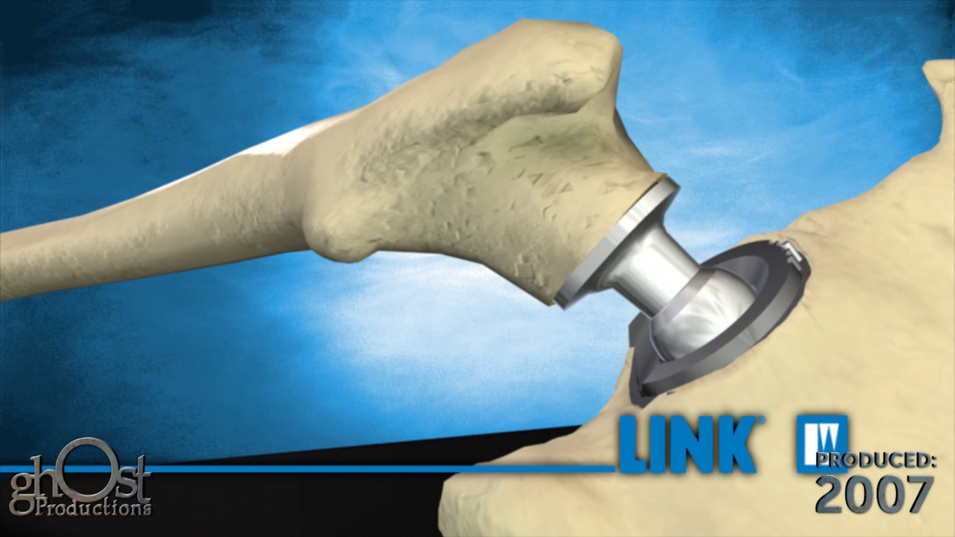 Orthopaedics, Ghost Productions, animation, CFP device, bioharmonic hip prosthesis system, young patients, active patients, durable solution, long-lasting solution, unique features, natural movement, hip joint, comfortable experience, functional experience, cutting-edge technology, game-changer, orthopaedics field, promising solution, active lifestyle.