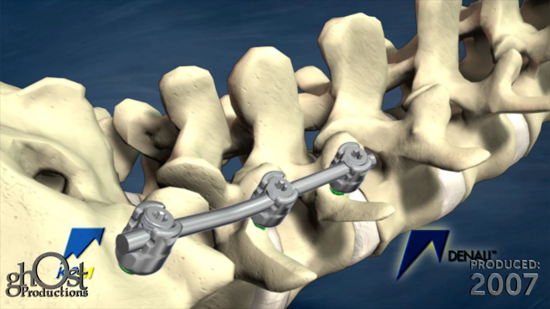 medical animation, K2M Denali Degenerative device, polyaxial pedicle screw system, lumbar spine fixation, degenerative spinal conditions, healthcare professionals, patients, spinal medicine, medical accuracy, features and benefits, Ghost Productions.