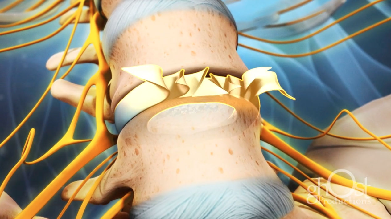Ghost Medical - Veritas Health - Understanding Herniated Discs (HD)