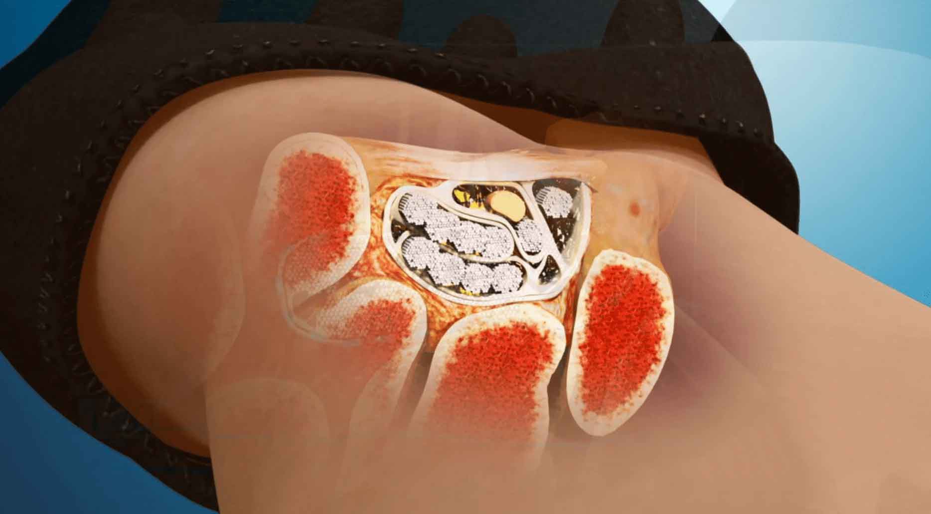 Medical Animation Case Study: iGO – Keo Carpal Tunnel Brace