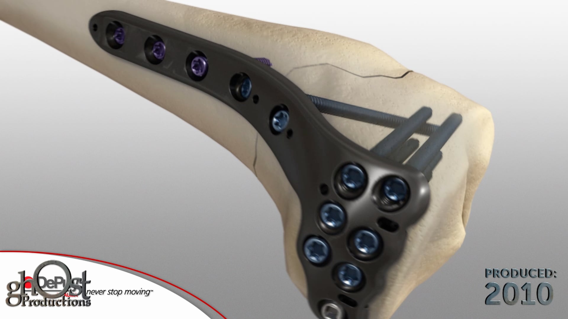 medical animation, Depuy, Proximal Tibia Plate, variable angle locking screw technology, traditional plating techniques, fixed-angle construct, customized trajectory, orthopedic surgery, Ghost Productions, benefits, surgeons, patients.
