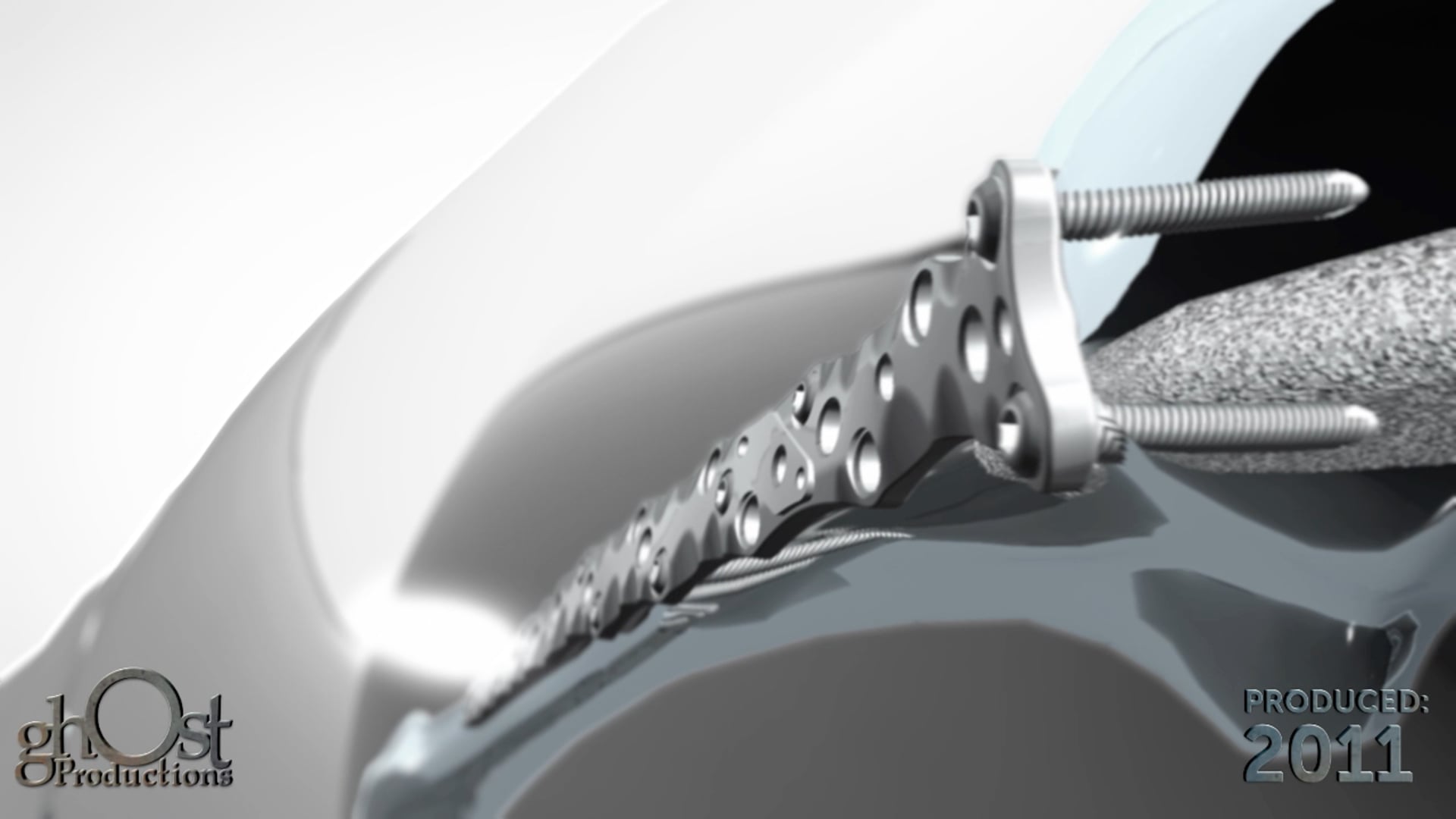 Zimmer Global, Ghost Productions, medical device company, leg plating systems, Glassman anatomy, orthopedics, medical professionals, innovative product, medical technology, patient outcomes.