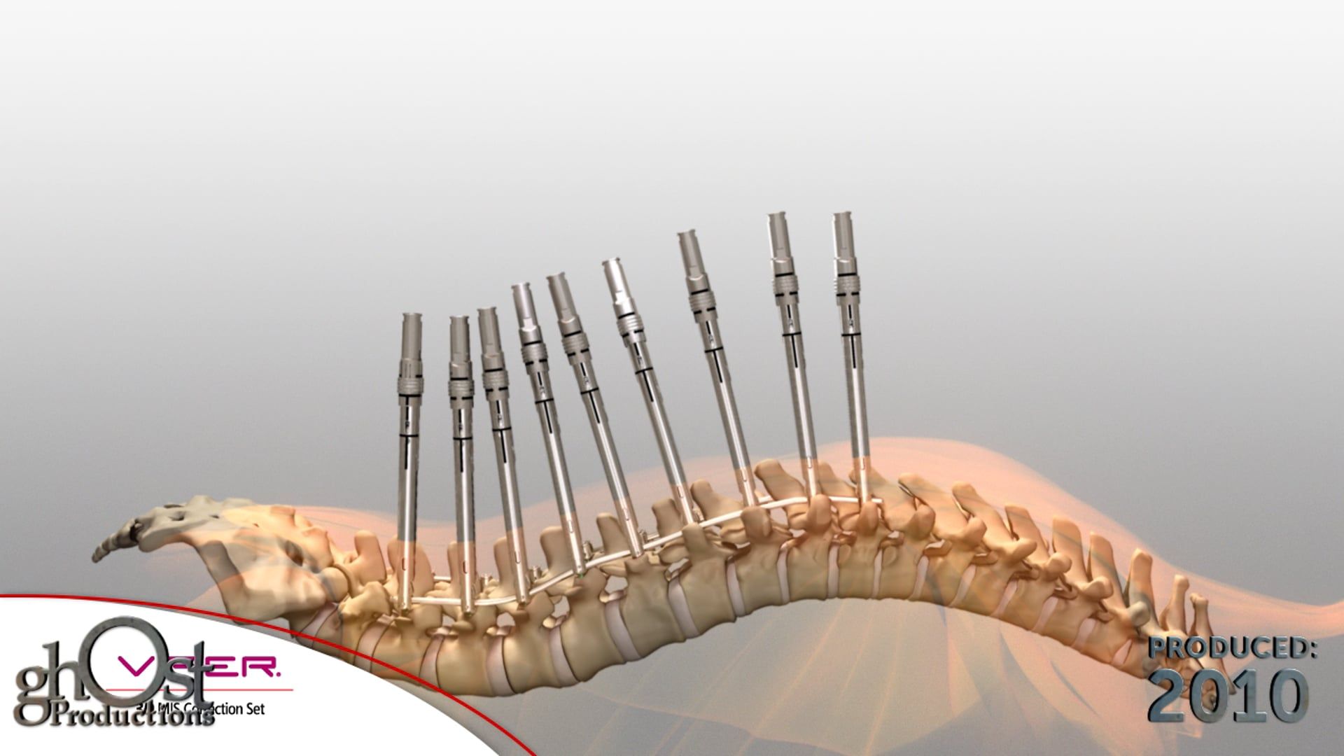 Depuy, Viper 3D, minimally invasive tool, surgeons, pathologies, thoracolumbar spine, Ghost Productions, animation, severe curvature, T7-L4 vertebrae, precise treatment, effective treatment, innovative technology, spinal surgery, medical clients, SEO.