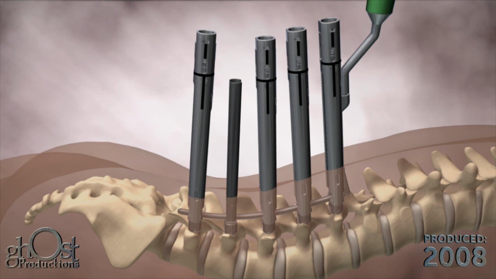 Depuy Spine, Ghost Productions, Viper 2, advanced rod holder system, spinal pathologies, minimally invasive approach, medical animation, healthcare professionals, patients, spinal surgery, medical device company, innovative technology, cutting-edge, features, benefits, informative.
