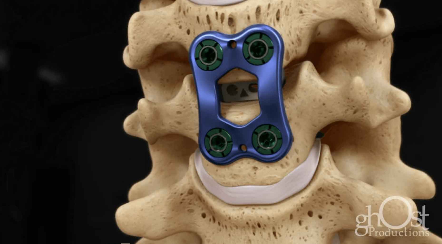 Medical Animation Case Study: Aesculap – Quintex and CeSpace Surgical Procedure
