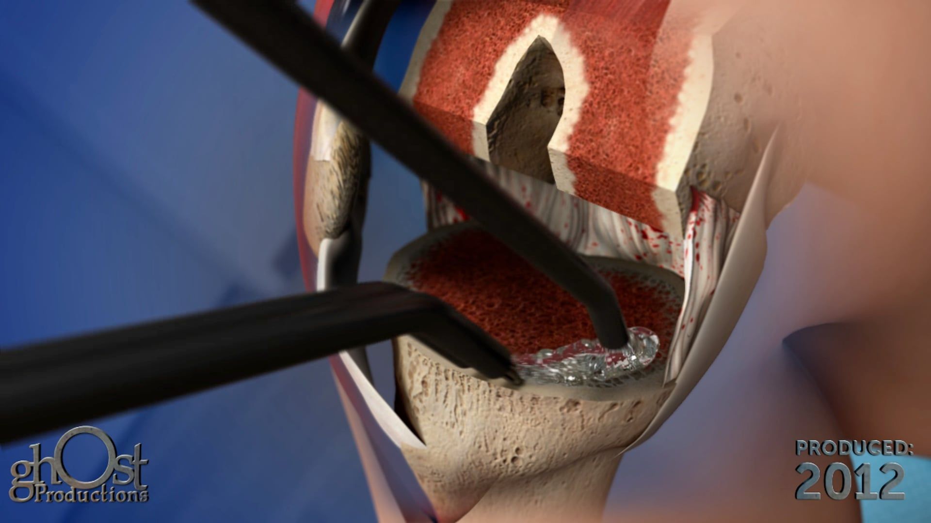 Ghost Medical Presents: Aquamantys Knee Animation