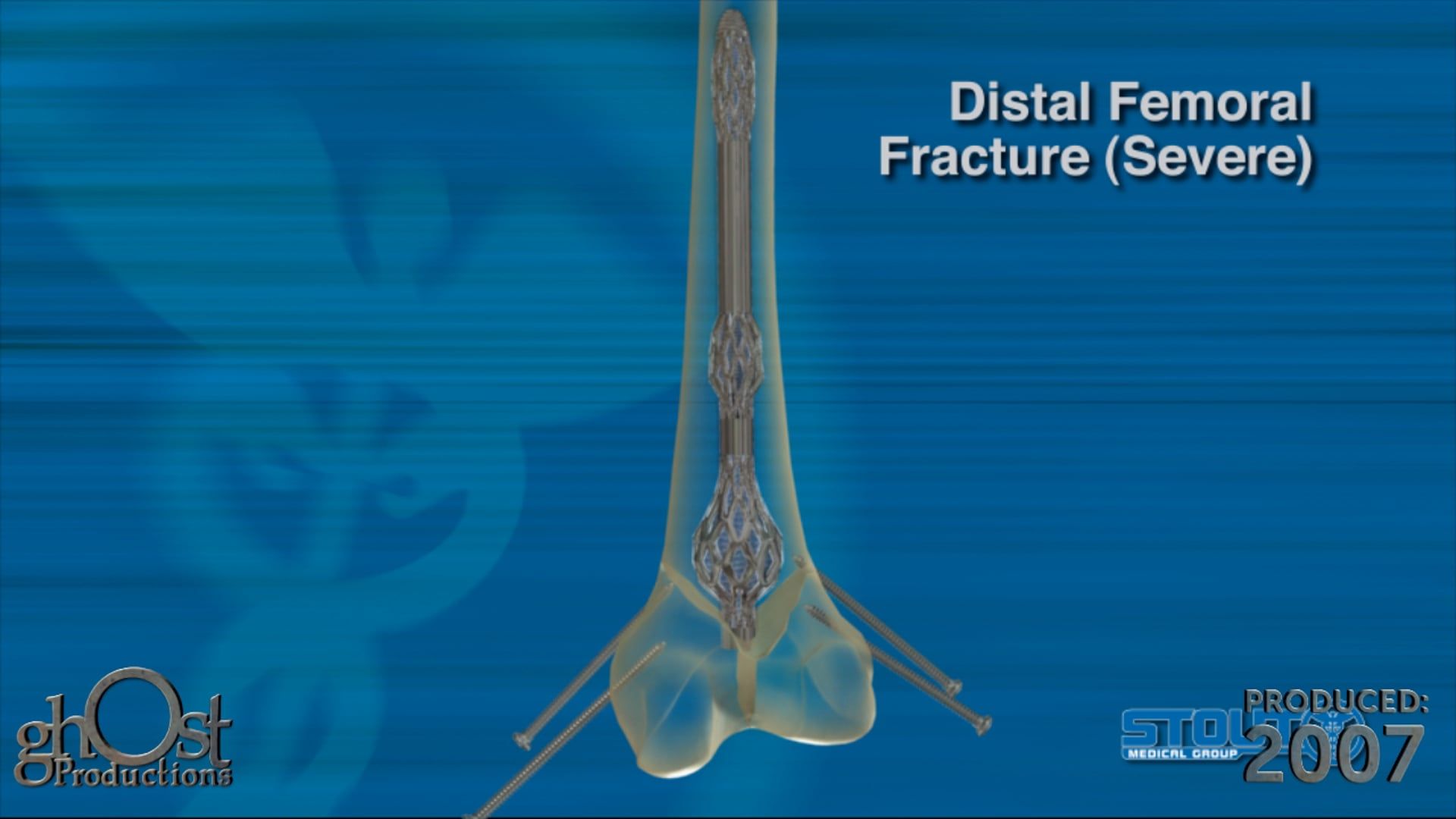 Ghost Medical presents: The Power of the Stout Expanding Anchor