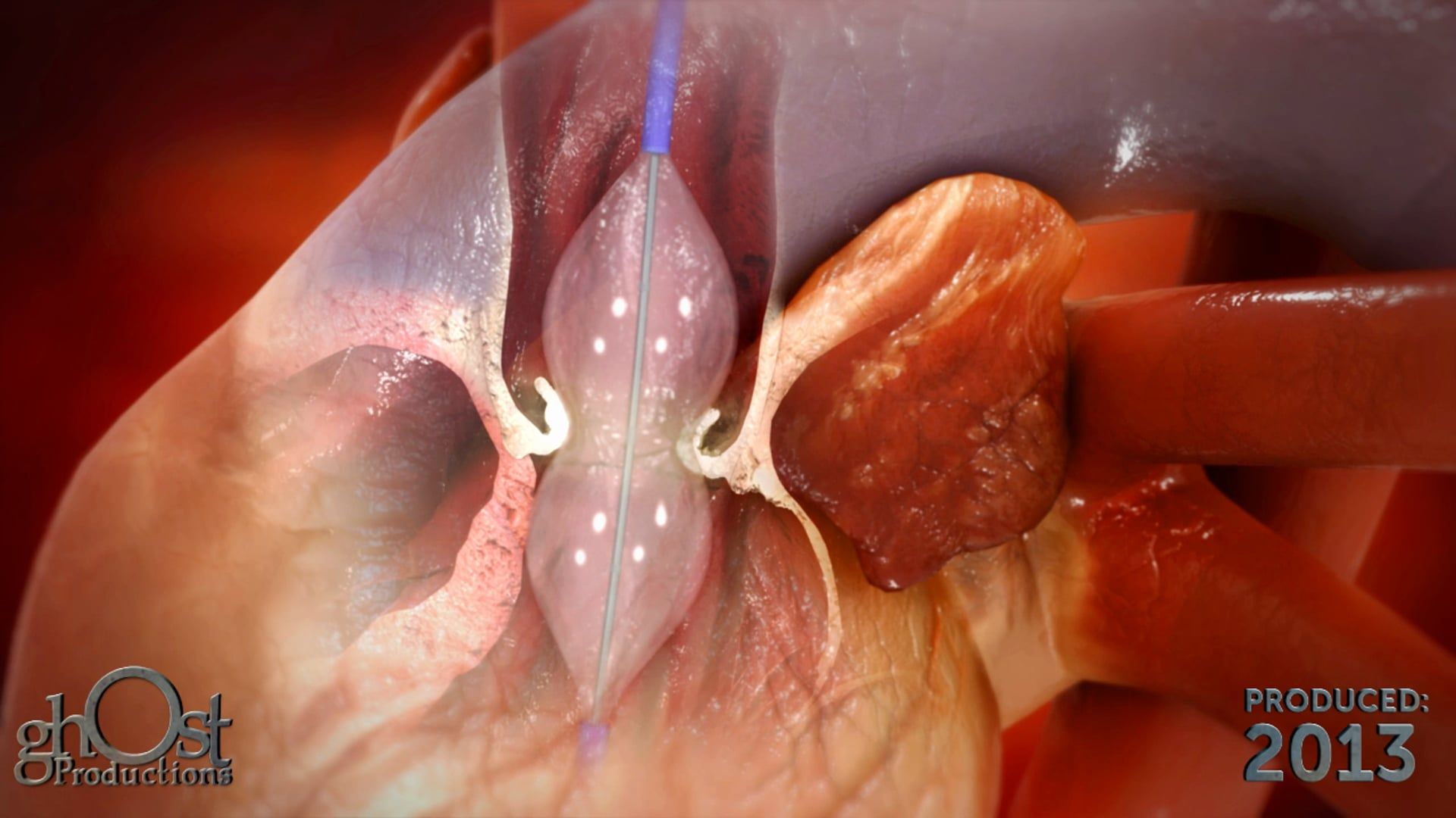 InterValve V8: A Revolutionary Medical Device by Ghost Medical