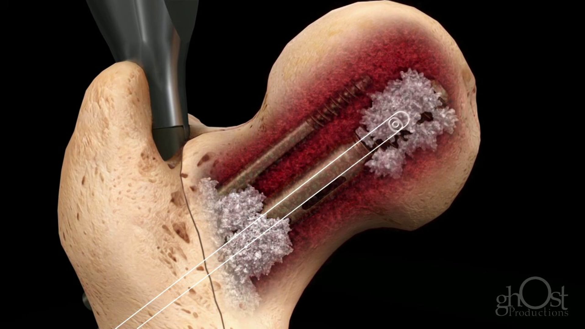 Ghost Medical - Orthogen Animation - Flownail - HD