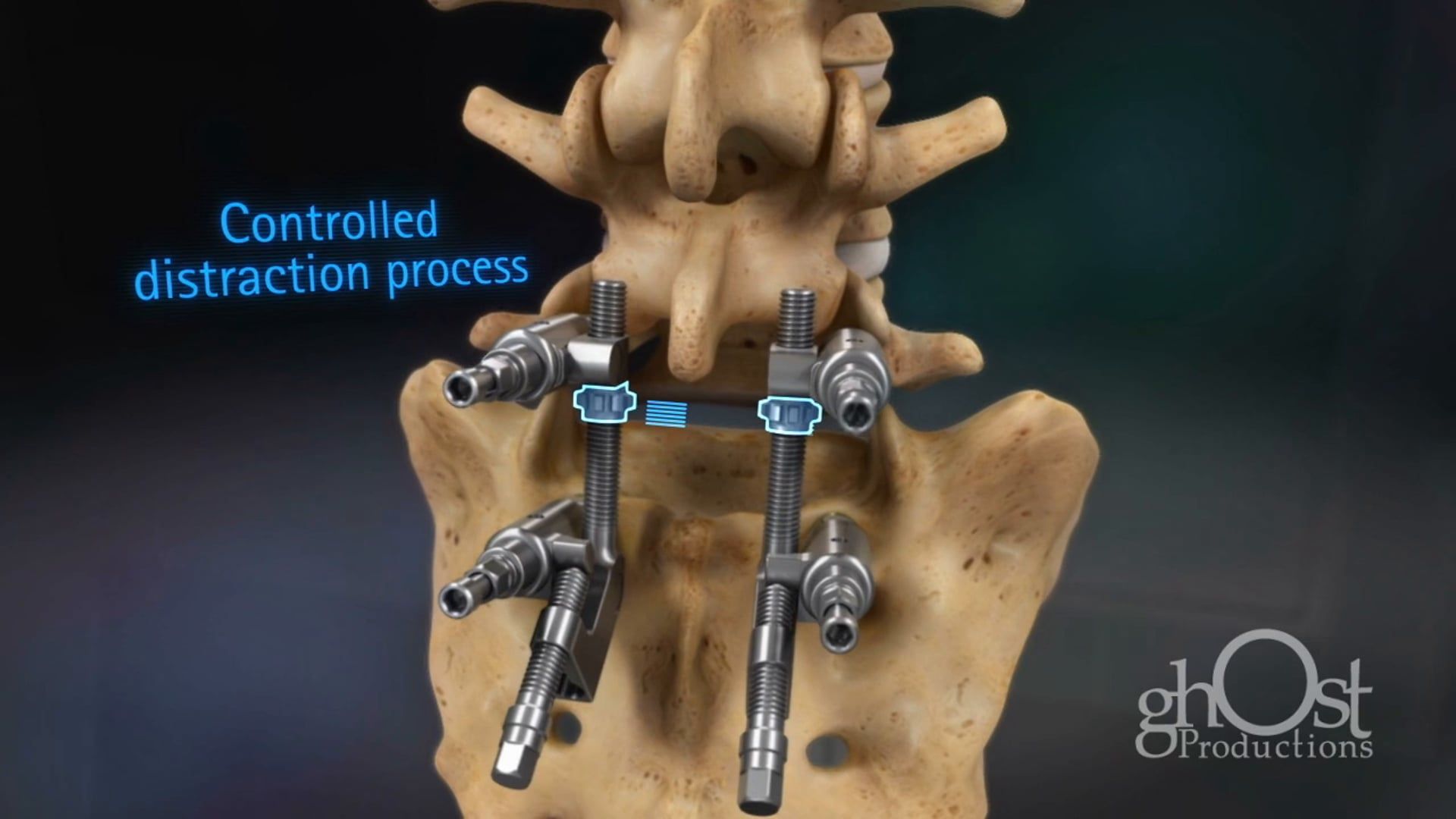 3D animation, Ghost Productions, Aesculap, S4 Spondylolisthesis Reduction Instrument, controlled placement, precise integration, medical device, orthopedic surgery, treatment, spondylolisthesis, attention to detail, accuracy, valuable tool, medical professionals, use, benefits.