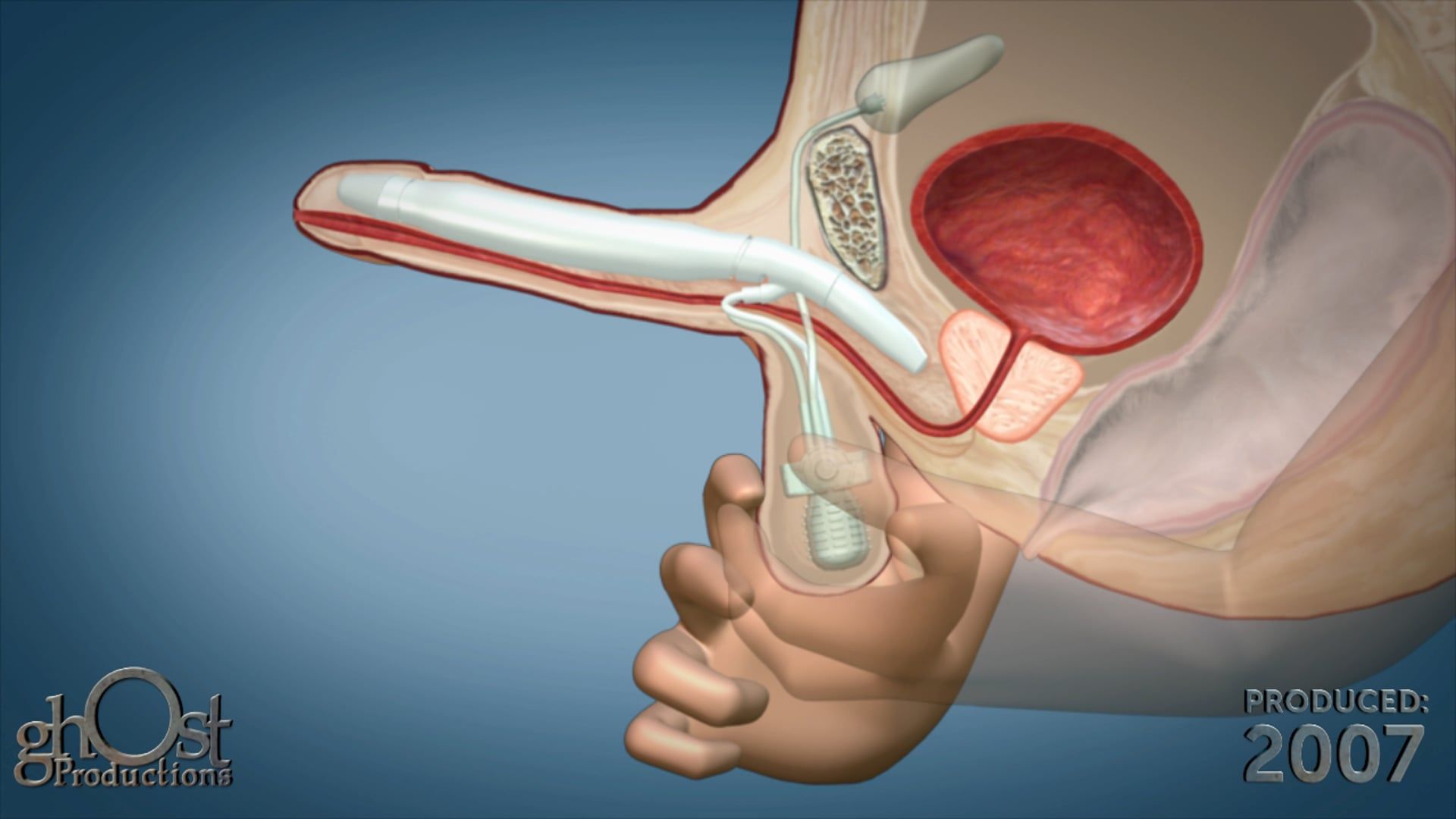 Ghost Productions offers a comprehensive animation of the 700MS penile implant with an integrated abdominal bladder and testicular inflation bulb.