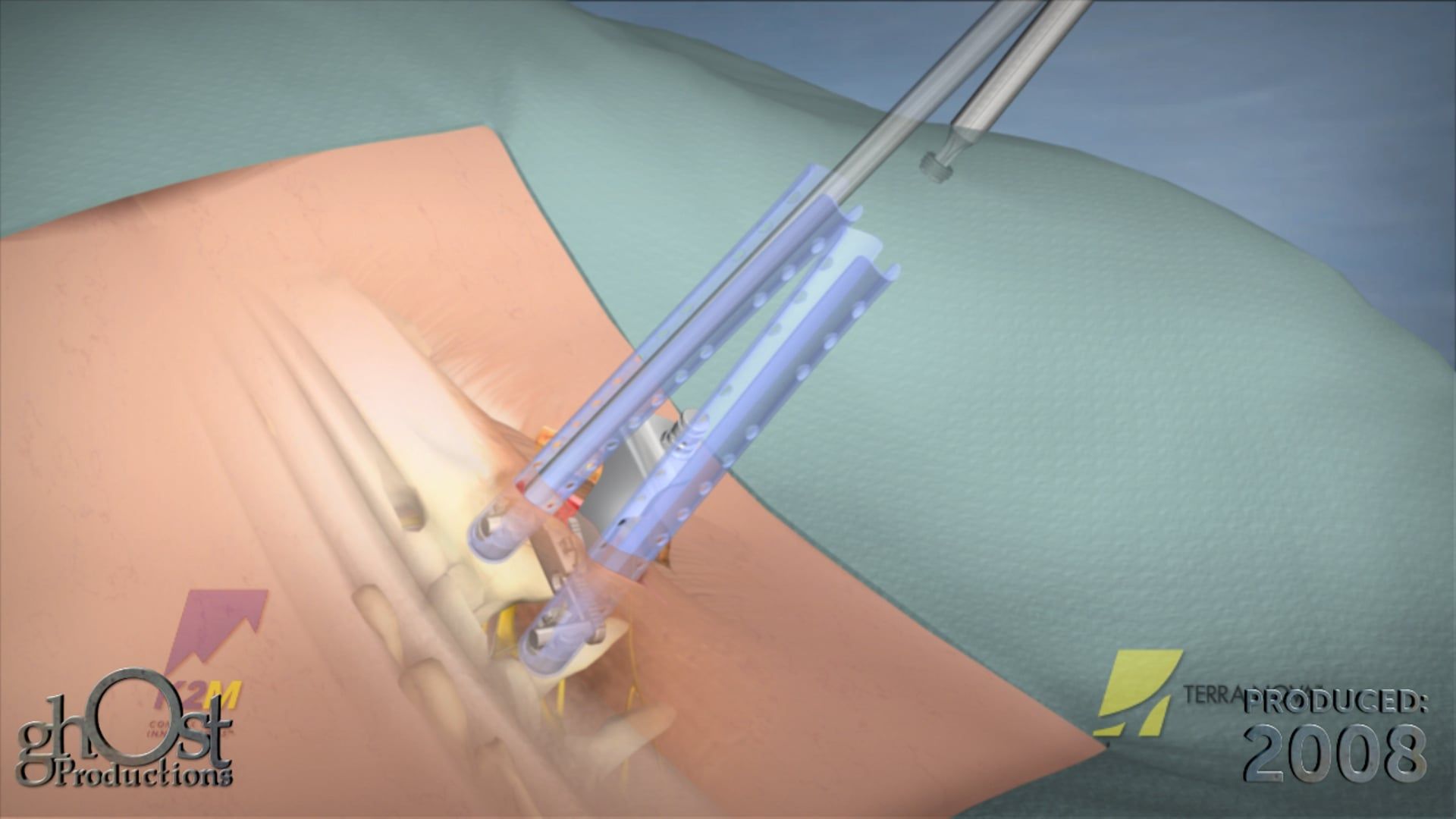 Ghost Medical Presents: The K2M TerraNova Animation