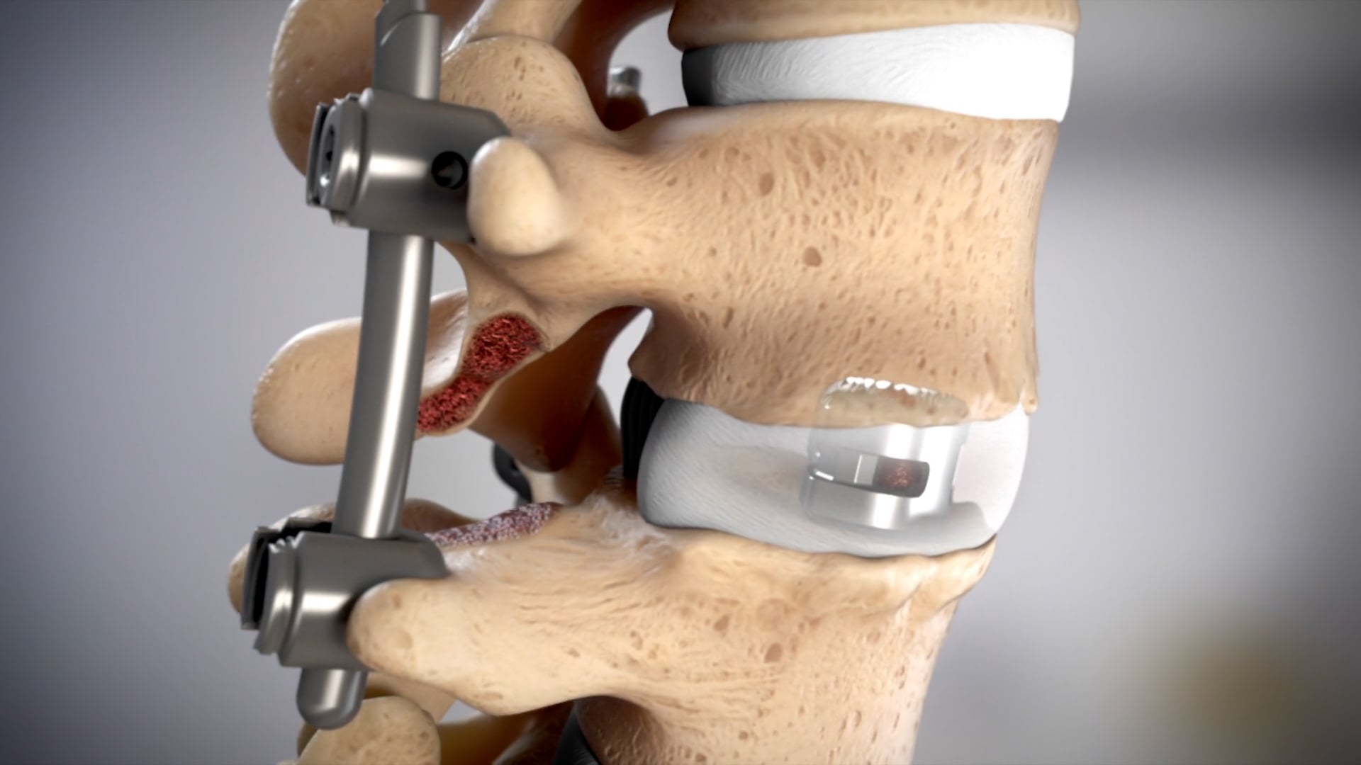 Ghost Medical Introduces DePuy Synthes MIS TLIF System