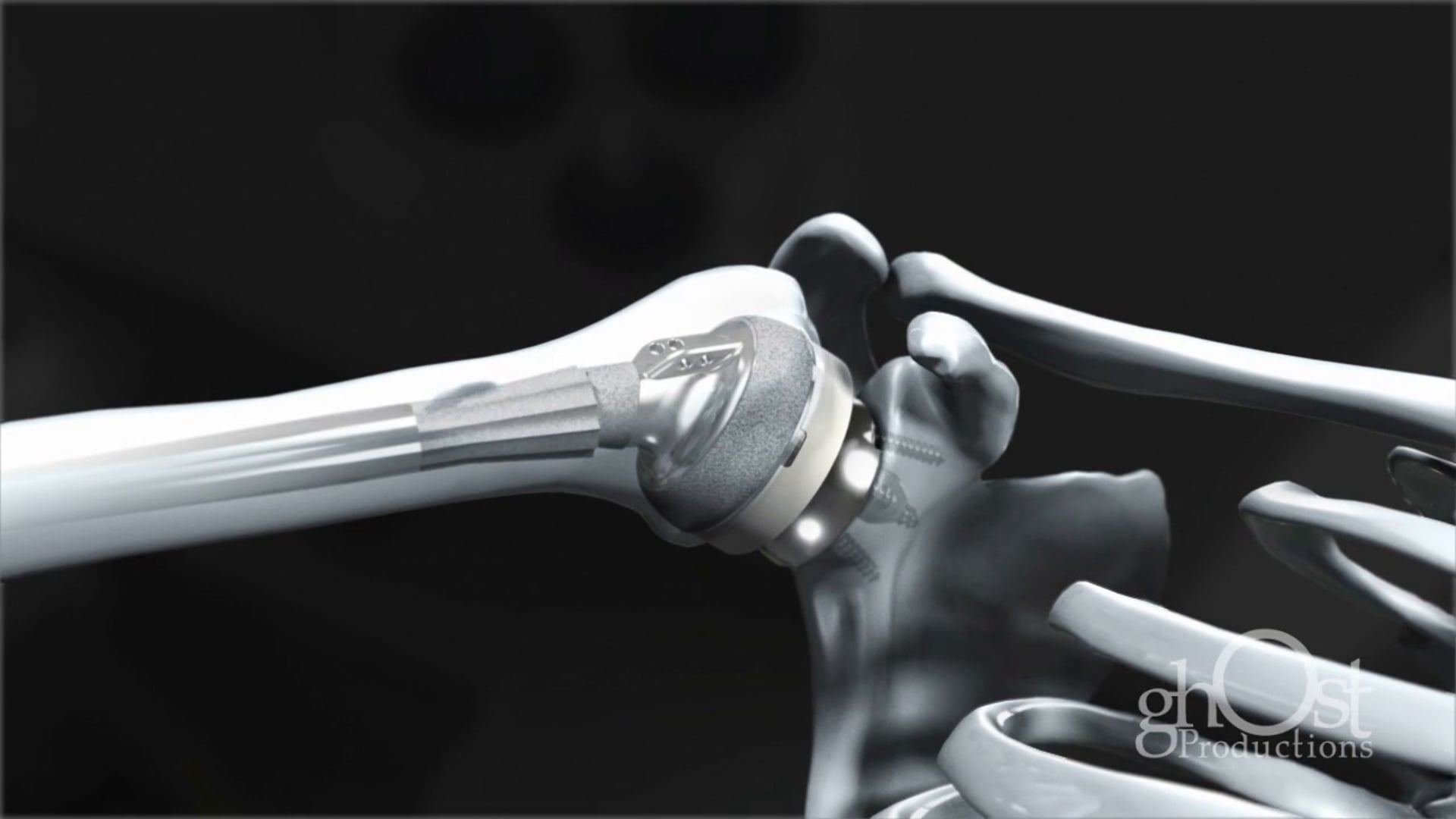 Shoulder Plates Medical Animation - HD Video - Ghost Medical for Integra Life Sciences