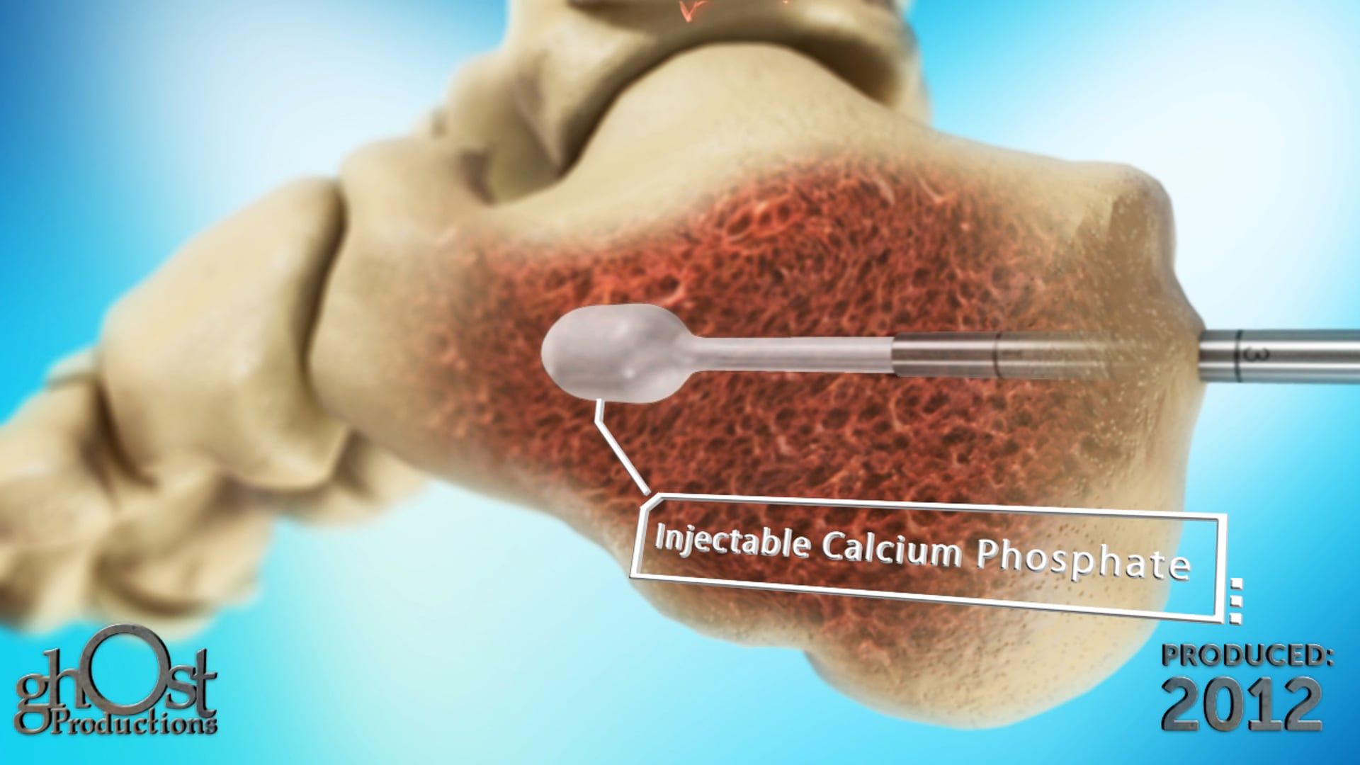 Medtronic, Ghost Productions, fracture management system, bone fractures, medical technology, healthcare professionals, patient outcomes, orthopedic medicine, character animation, innovative system, advanced features, comprehensive overview, medically accurate, powerful tool, collaboration, significant impact.