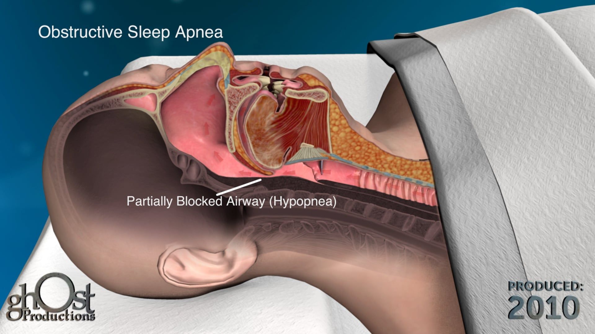 Apnex electrical stimulus device treats sleep apnea by delivering an electrical pulse to prevent airway obstruction during sleep. Revolutionizing sleep medicine.